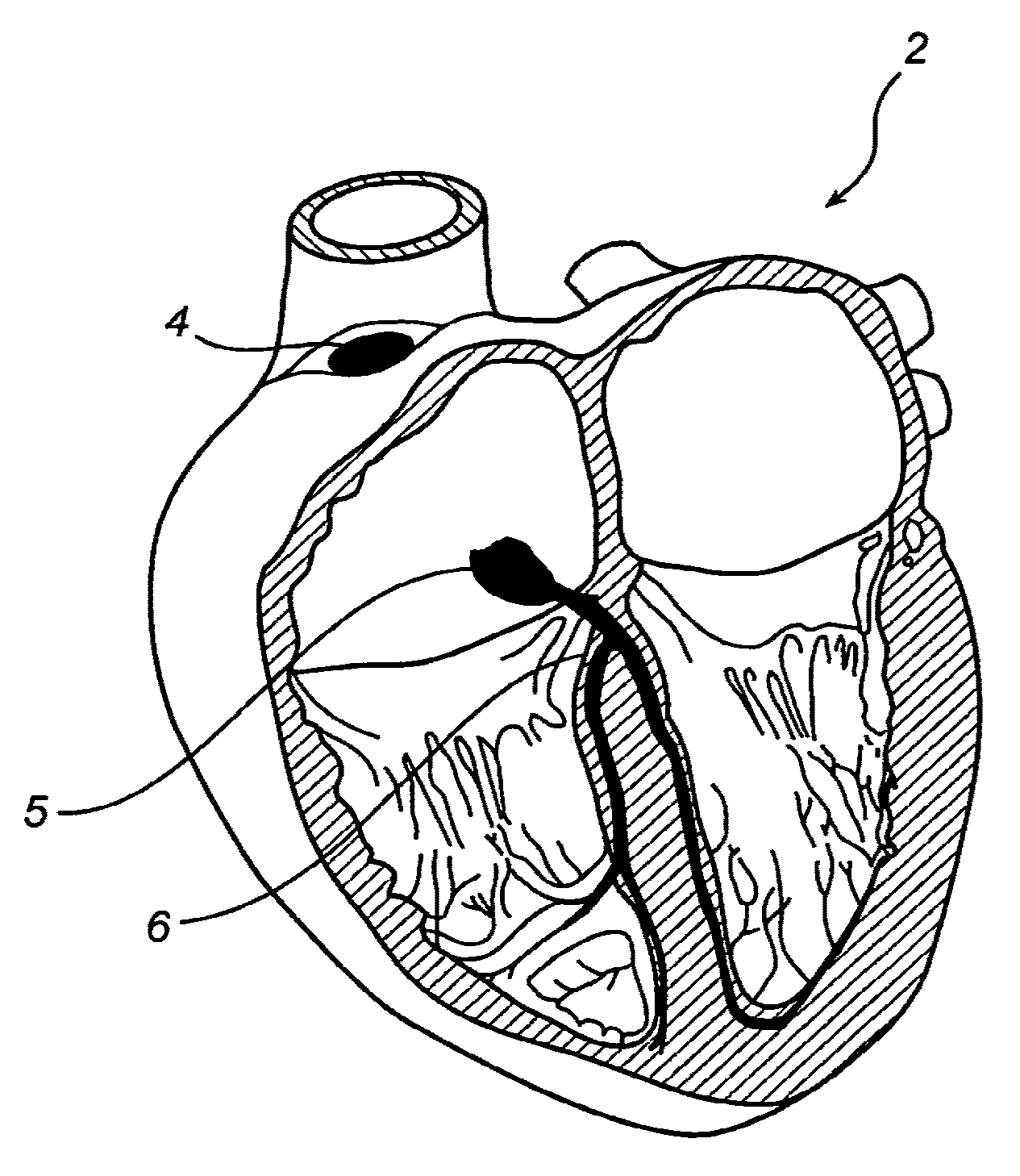 Device, A Kit And A Method For Treatment Of Disorders In The Heart Rhythm Regulation System