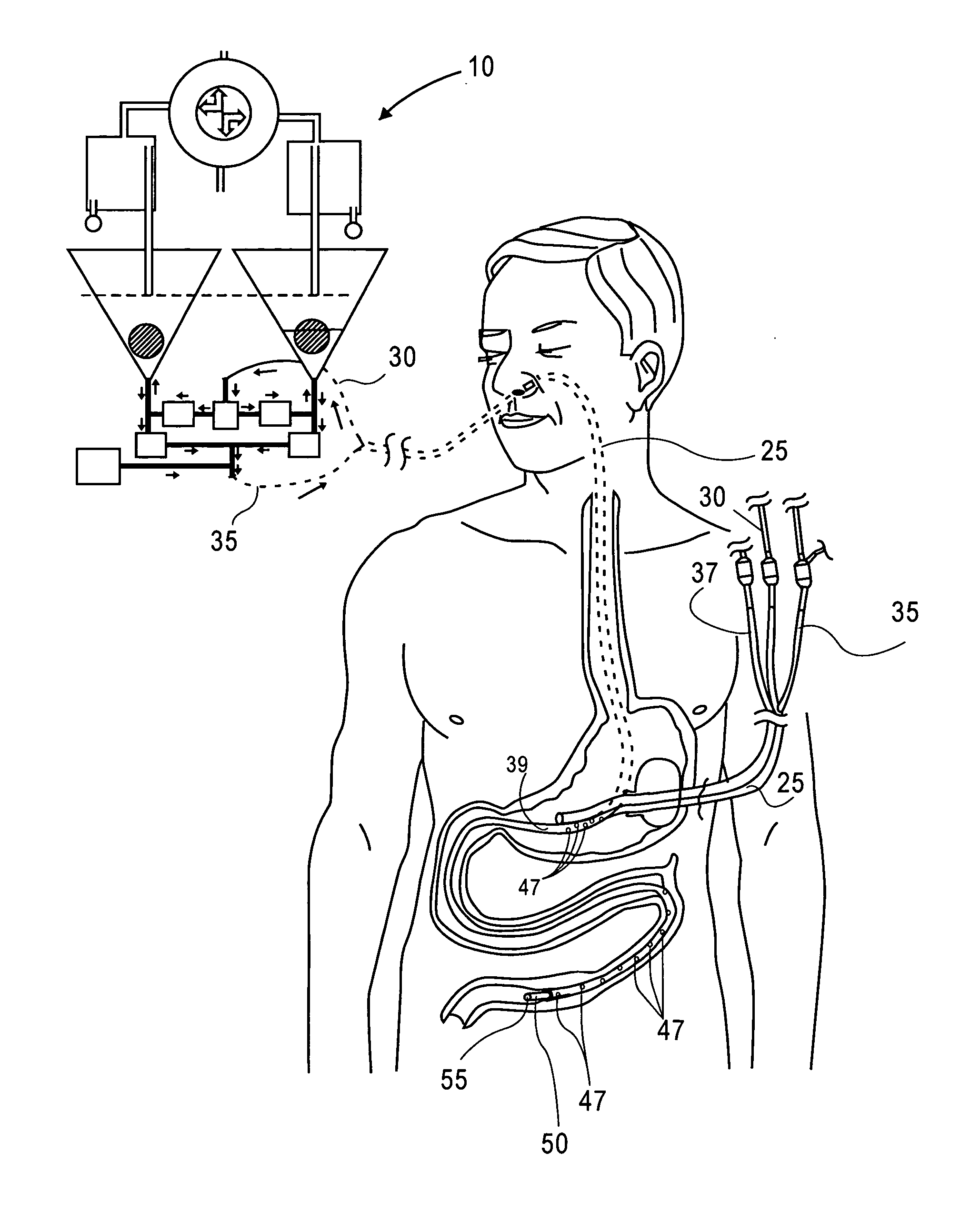Method and apparatus for suctioning and refeeding gastric juices