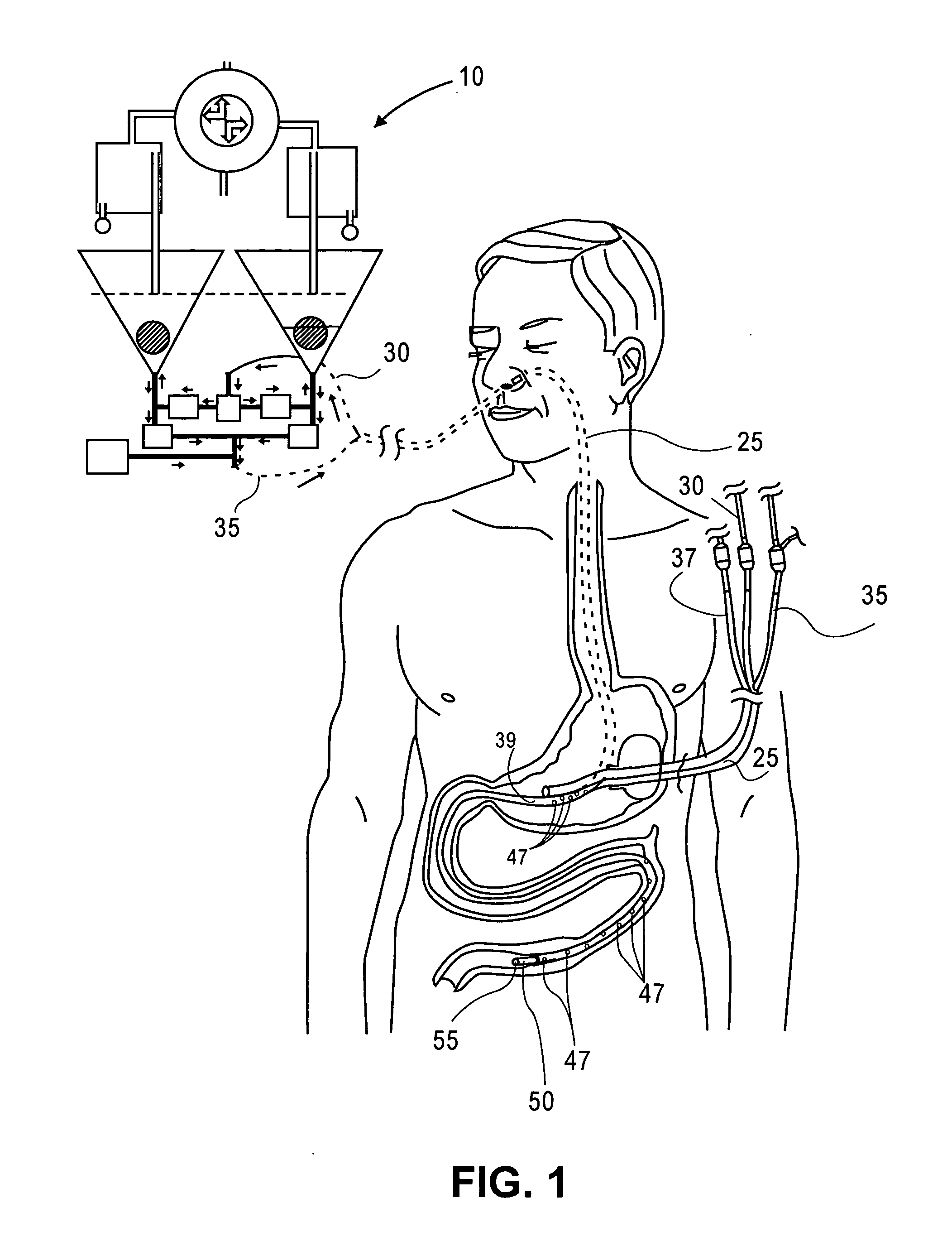 Method and apparatus for suctioning and refeeding gastric juices
