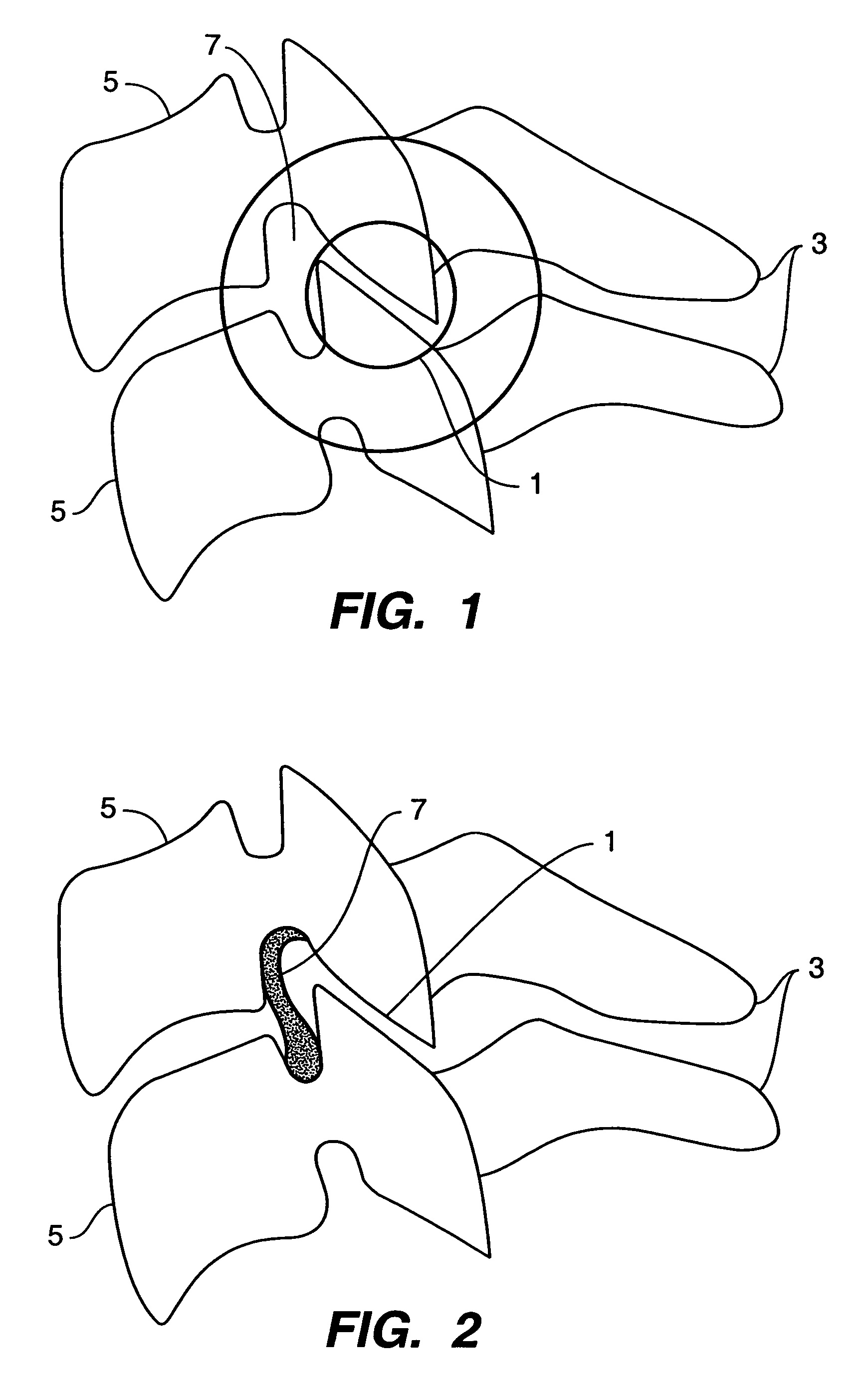 Inter-cervical facet implant with locking screw and method