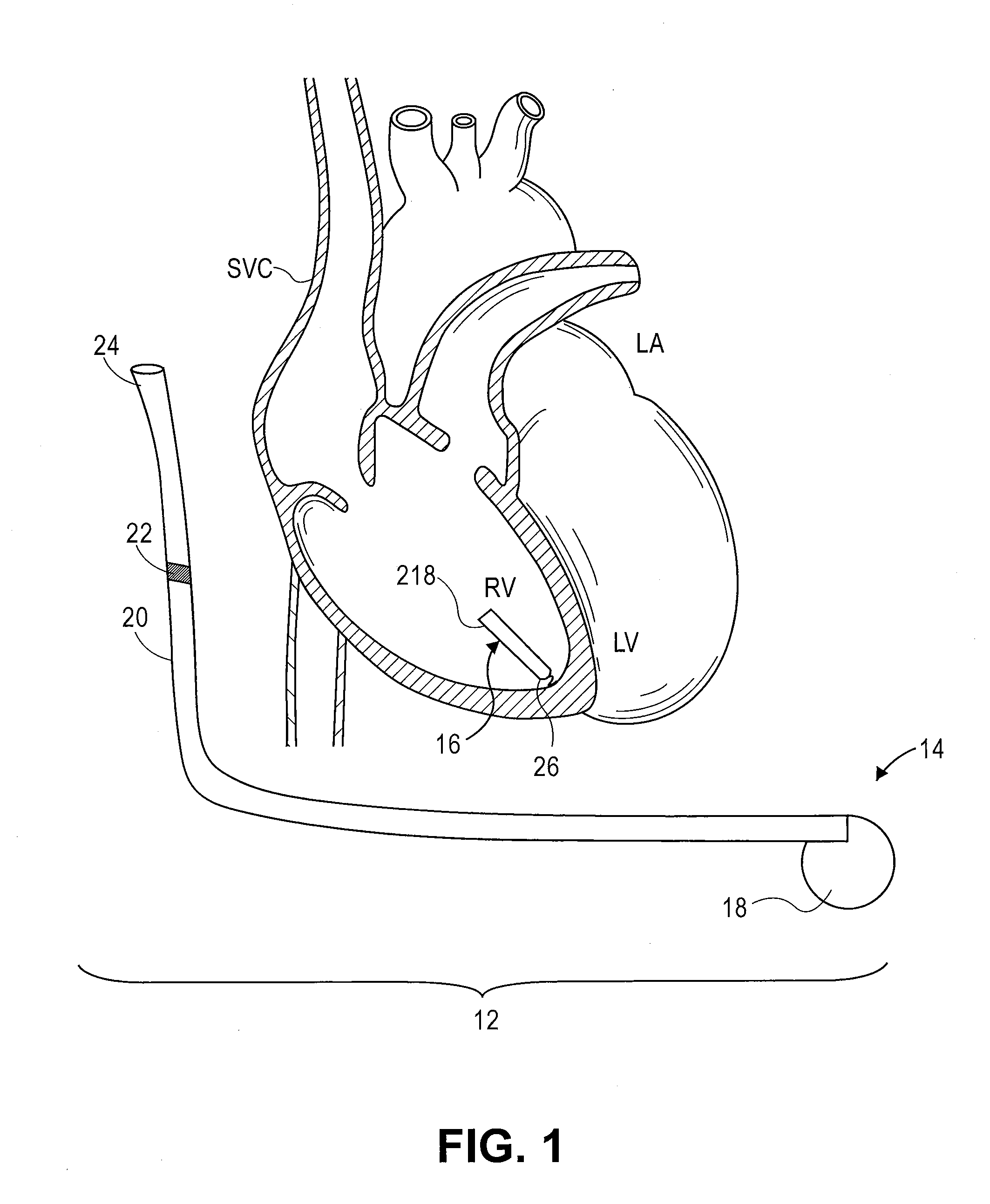 Method and system for tracking events of interest between leadless and subcutaneous implantable cardioverter devices