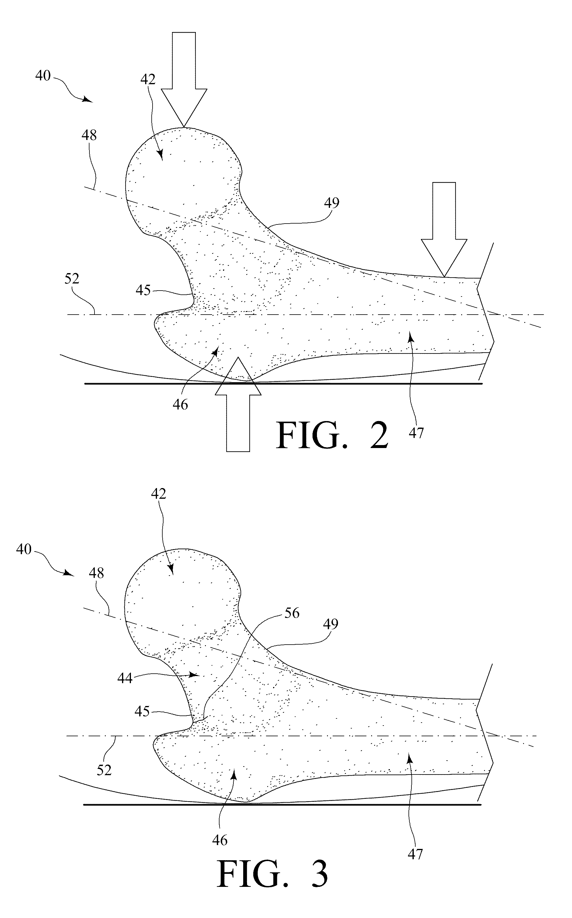 Device and method to prevent hip fractures