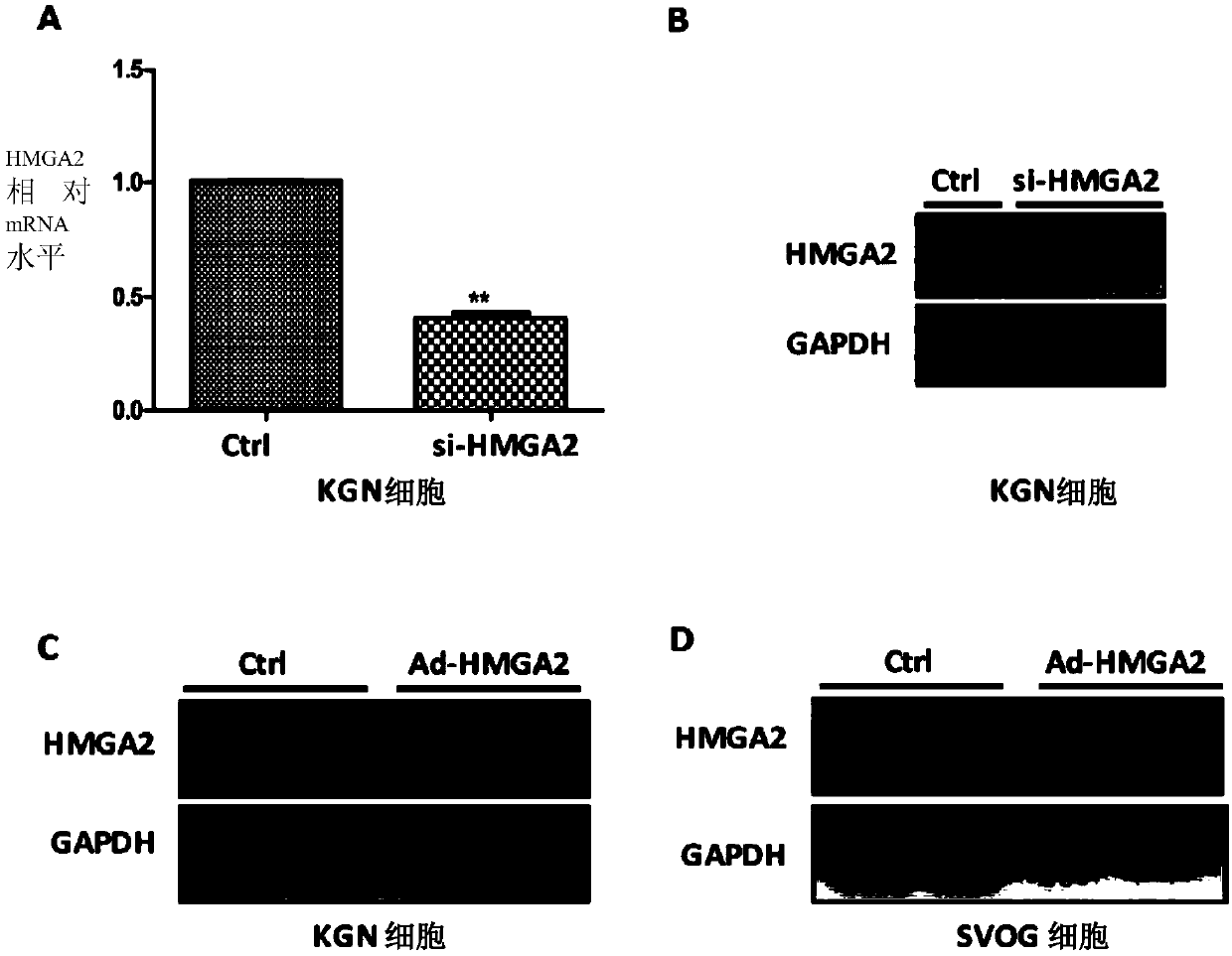 Application of HMGA2 gene in polycystic ovary syndrome disease