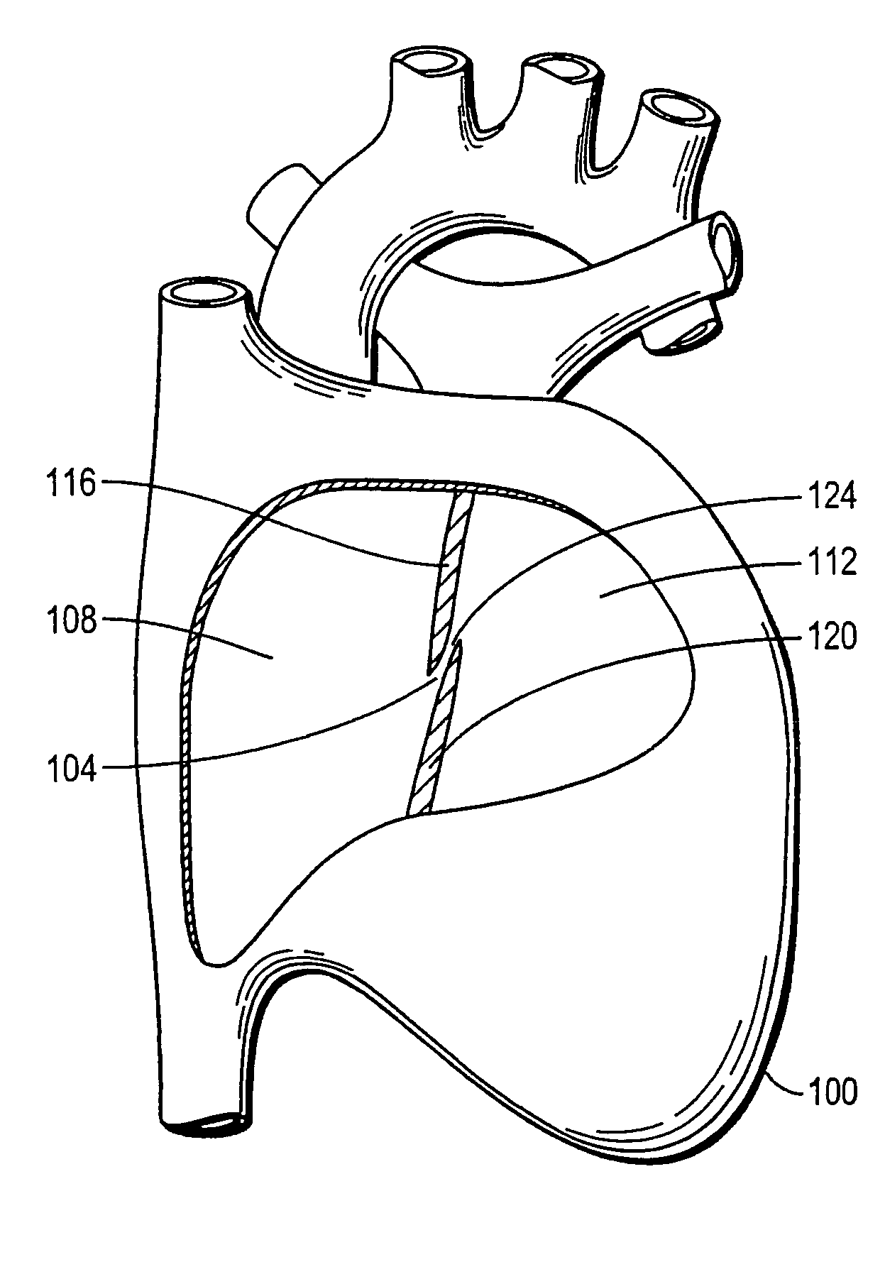 Device with biological tissue scaffold for percutaneous closure of an intracardiac defect and methods thereof