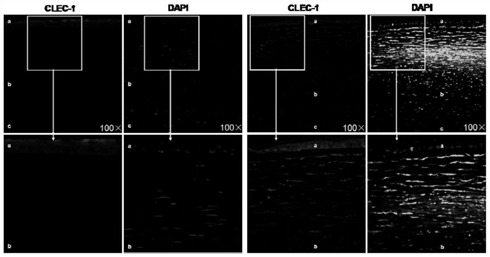 Application of C-type lectin-like receptor-1 as therapeutic marker of fungal keratitis