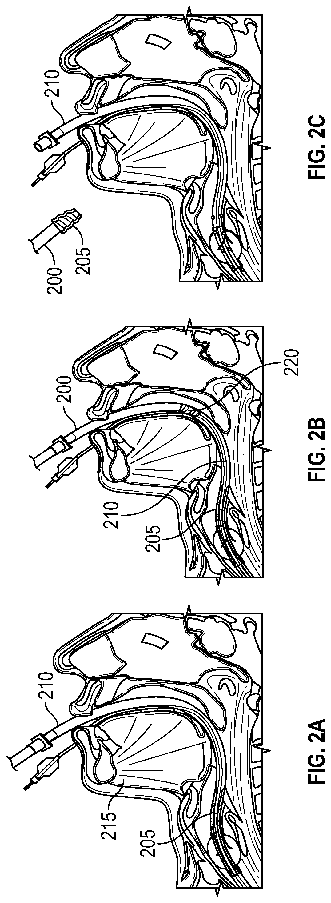 Biofilm removal device for endotracheal tubes