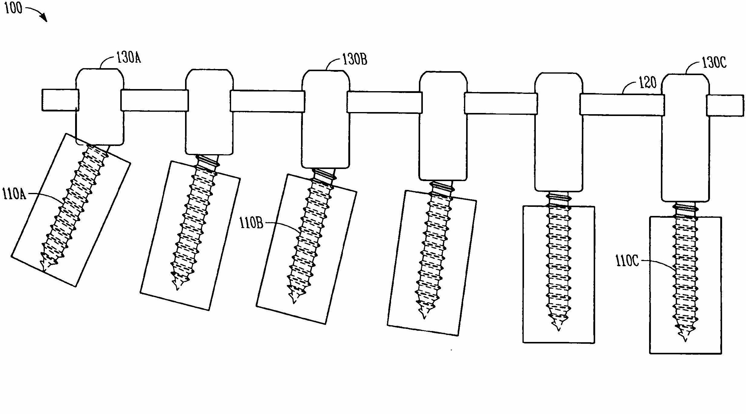 Variable offset spine fixation system and method
