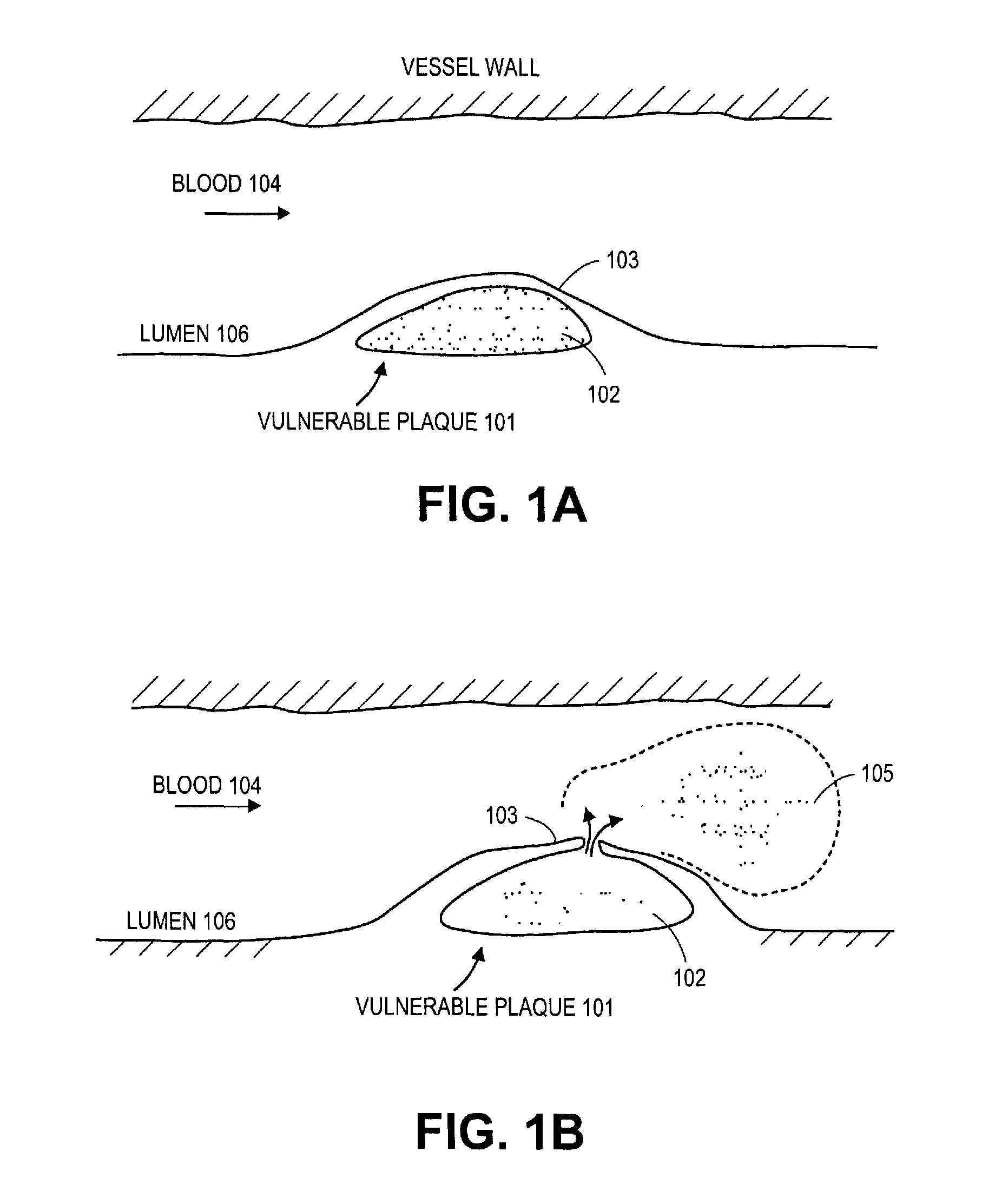 Method and apparatus for rupturing a vulnerable plaque