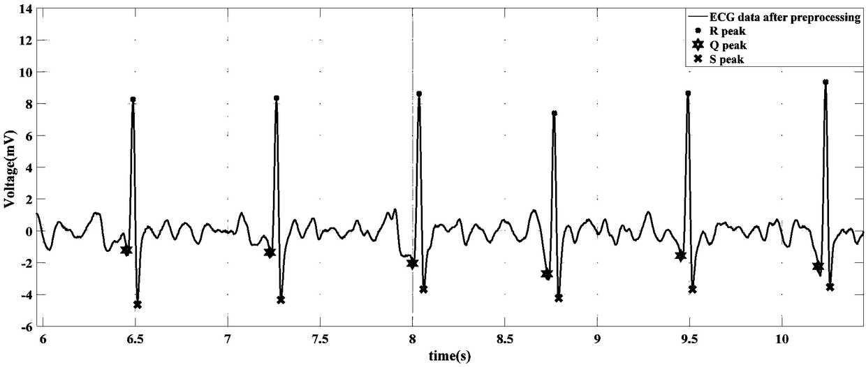 Real-time QRS-wave detection method for electrocardiosignals