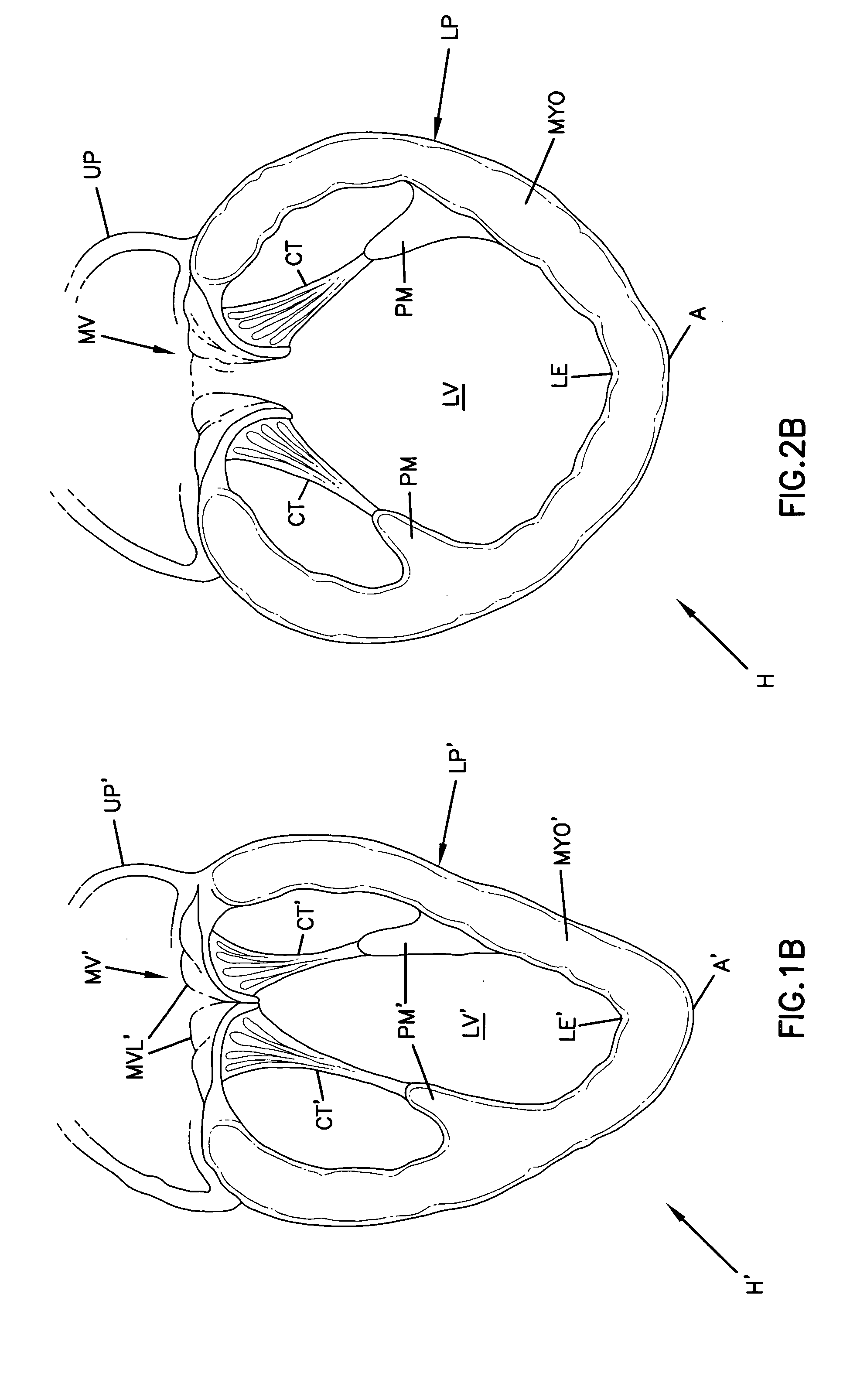 Cardiac support device