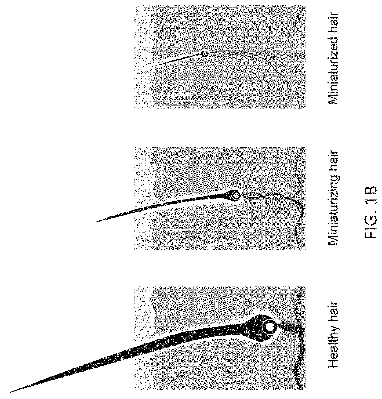 Cranial hair loss treatment using micro-energy acoustic shock wave devices and methods