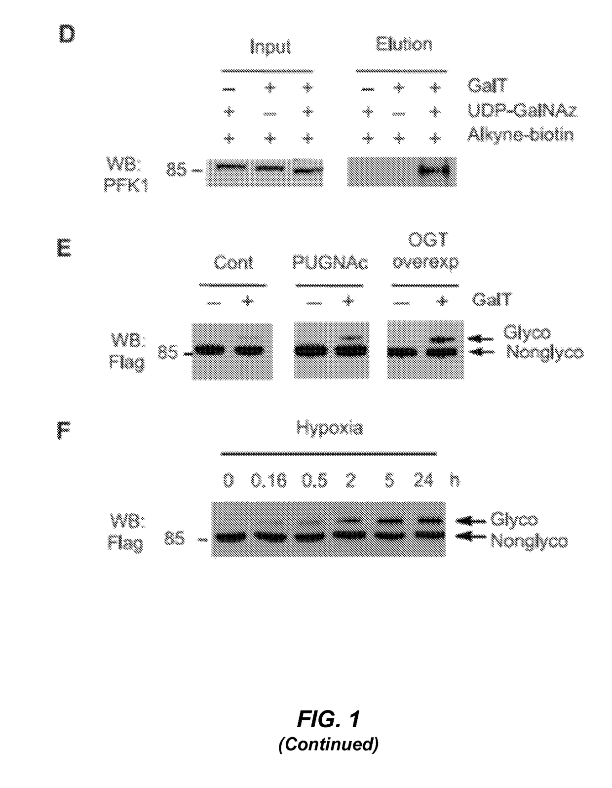 Targeting phosphofructokinase and its glycosylation form for cancer