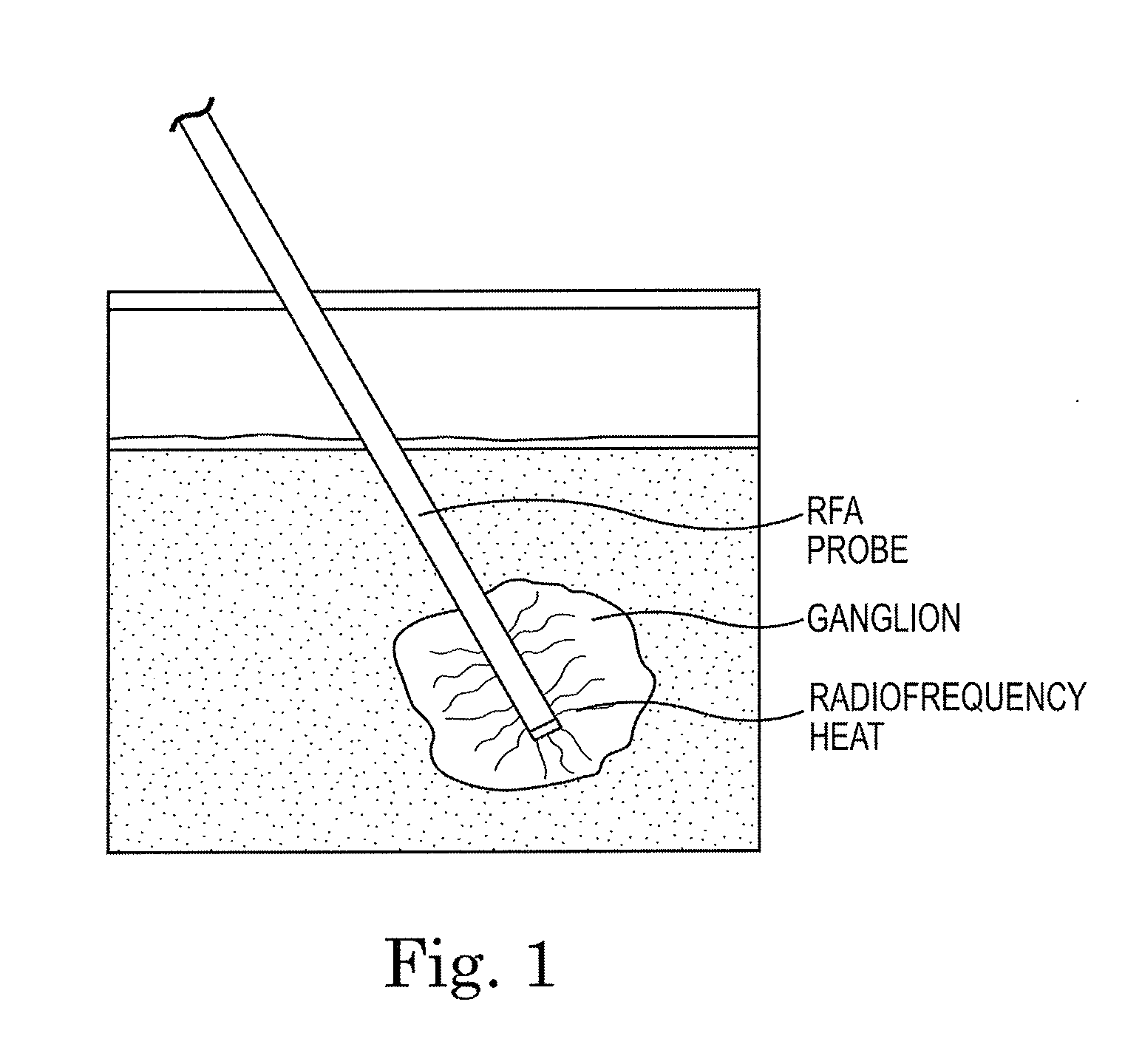 System and method of trans-abdominal pre-aortic ganglion ablation