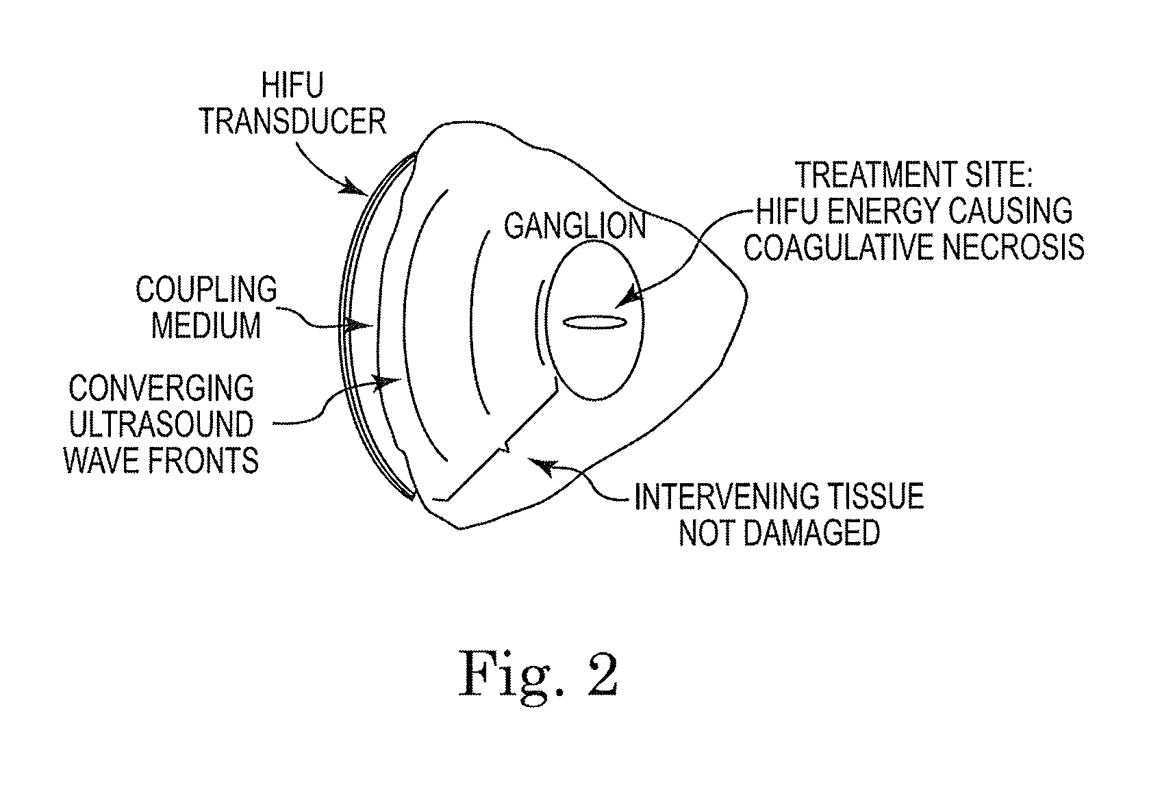 System and method of trans-abdominal pre-aortic ganglion ablation