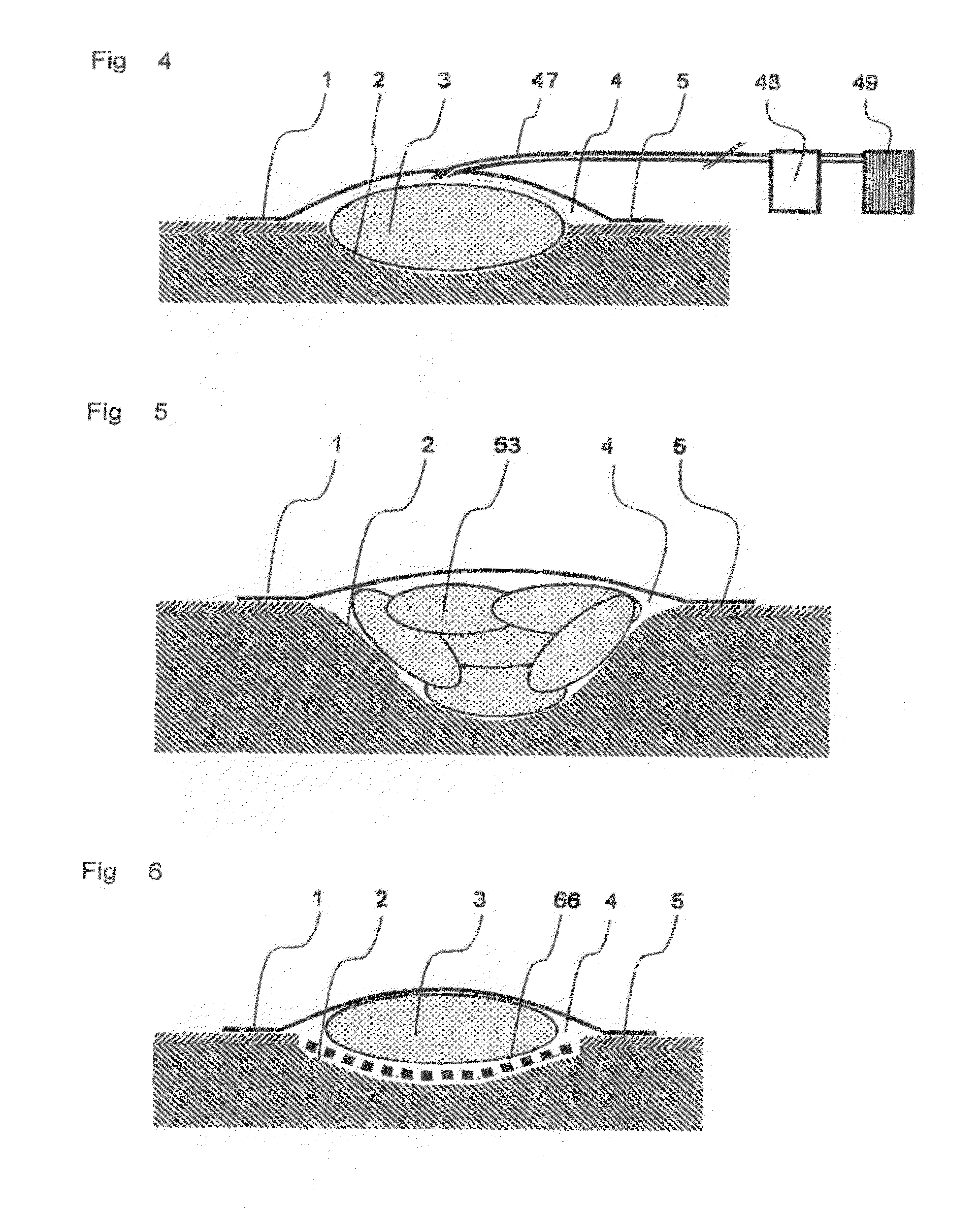 Device for vacuum therapy of wounds