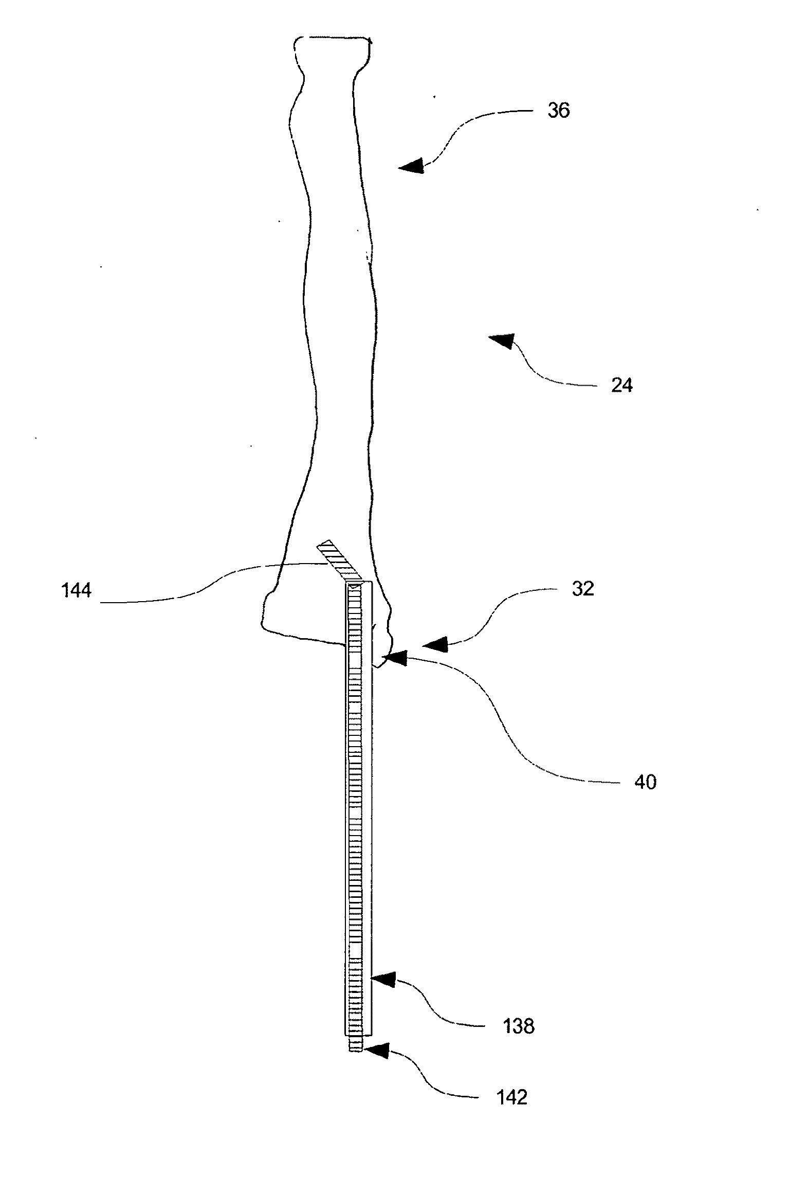 Method and kit for intra osseous navigation and augmentation of bone