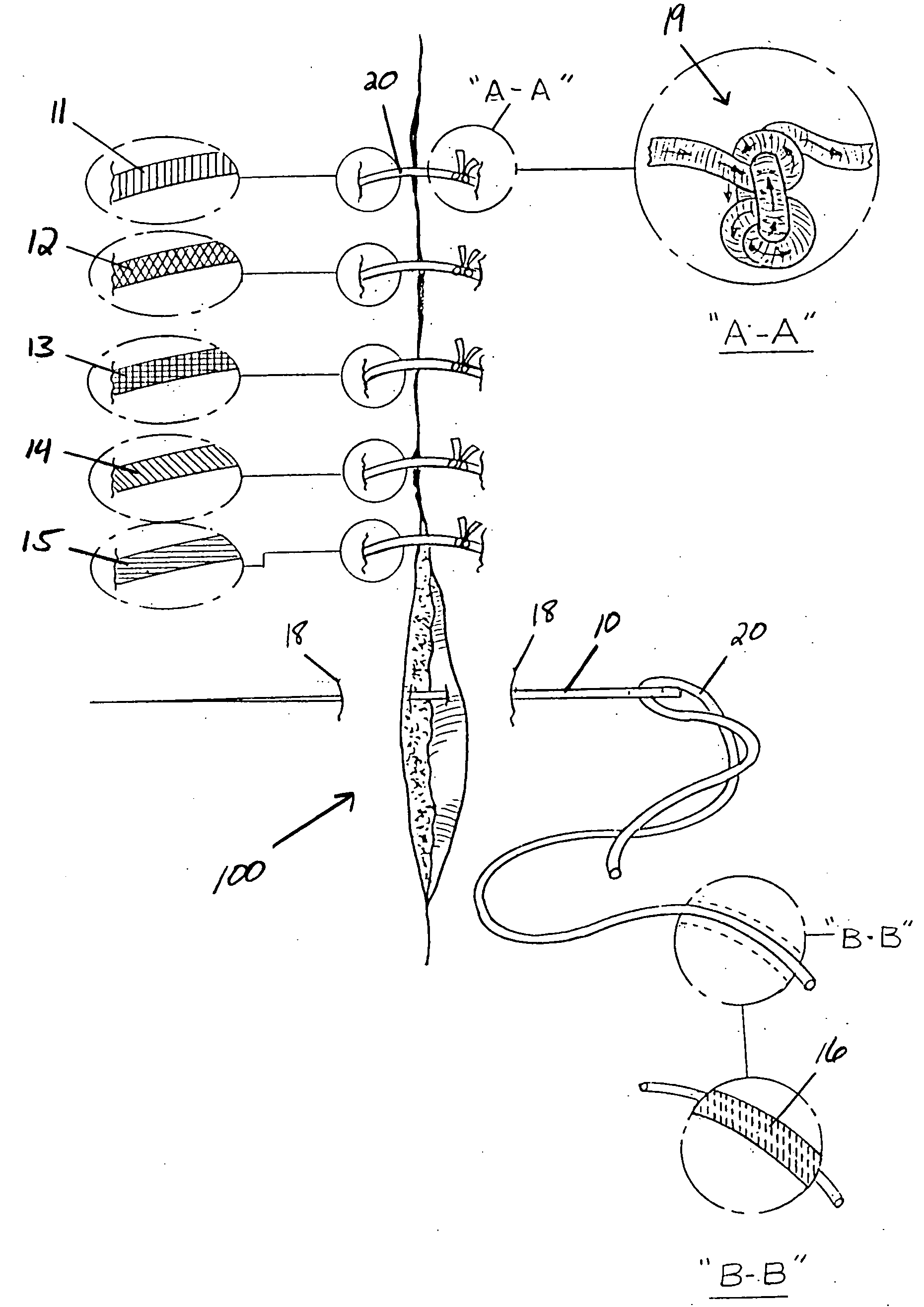 Suture treatment method and kit therefor