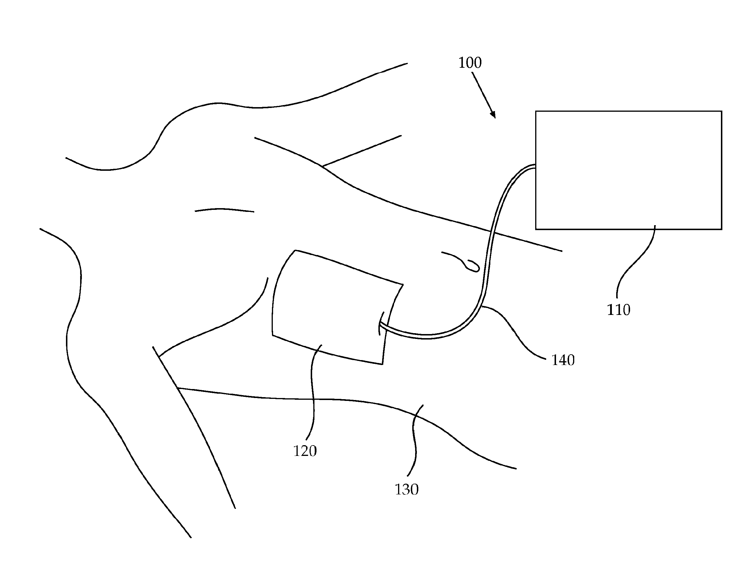 Devices And Methods For Detection Of Internal Bleeding And Hematoma