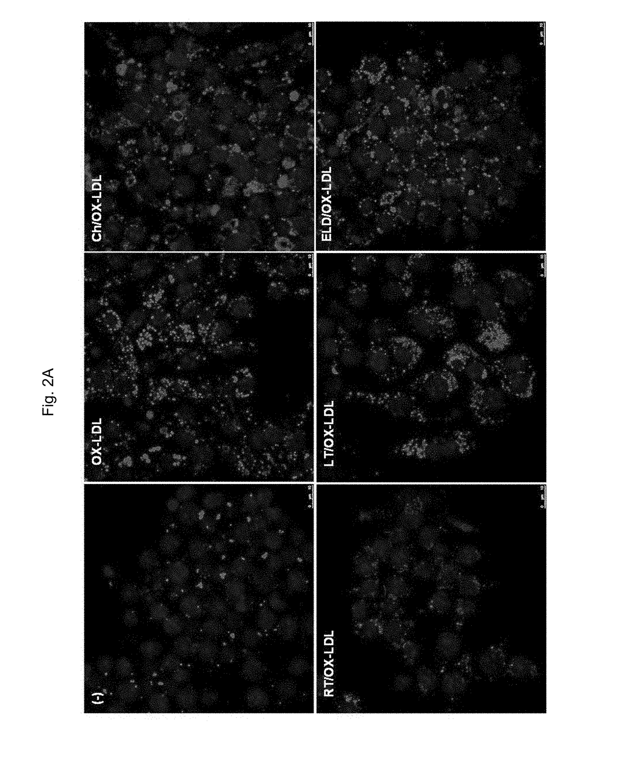 Method of treating macrophage foam cell formation and diseases associated with macrophage foam cell formation