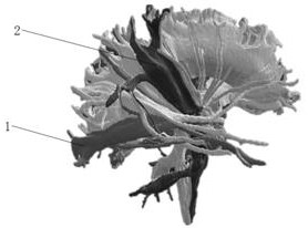 Deep brain tumor and white matter fiber bundle relation model and preparation method thereof