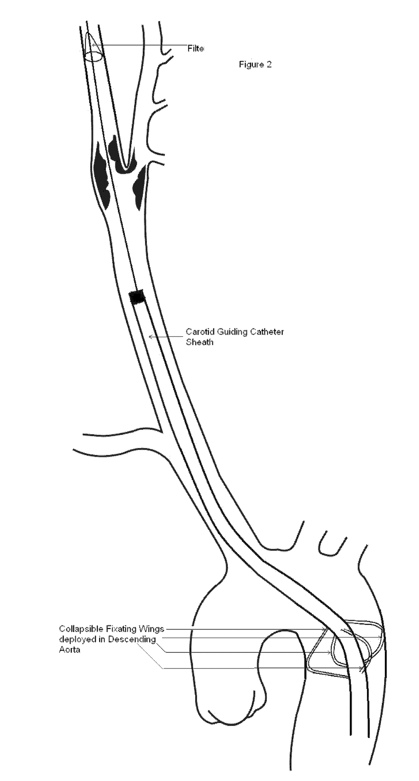 Carotid guiding catheter (sheath) for carotid percutaneous intervention/stenting with internal fixation device to prevent migration of the Carotid guiding catheter (sheath)