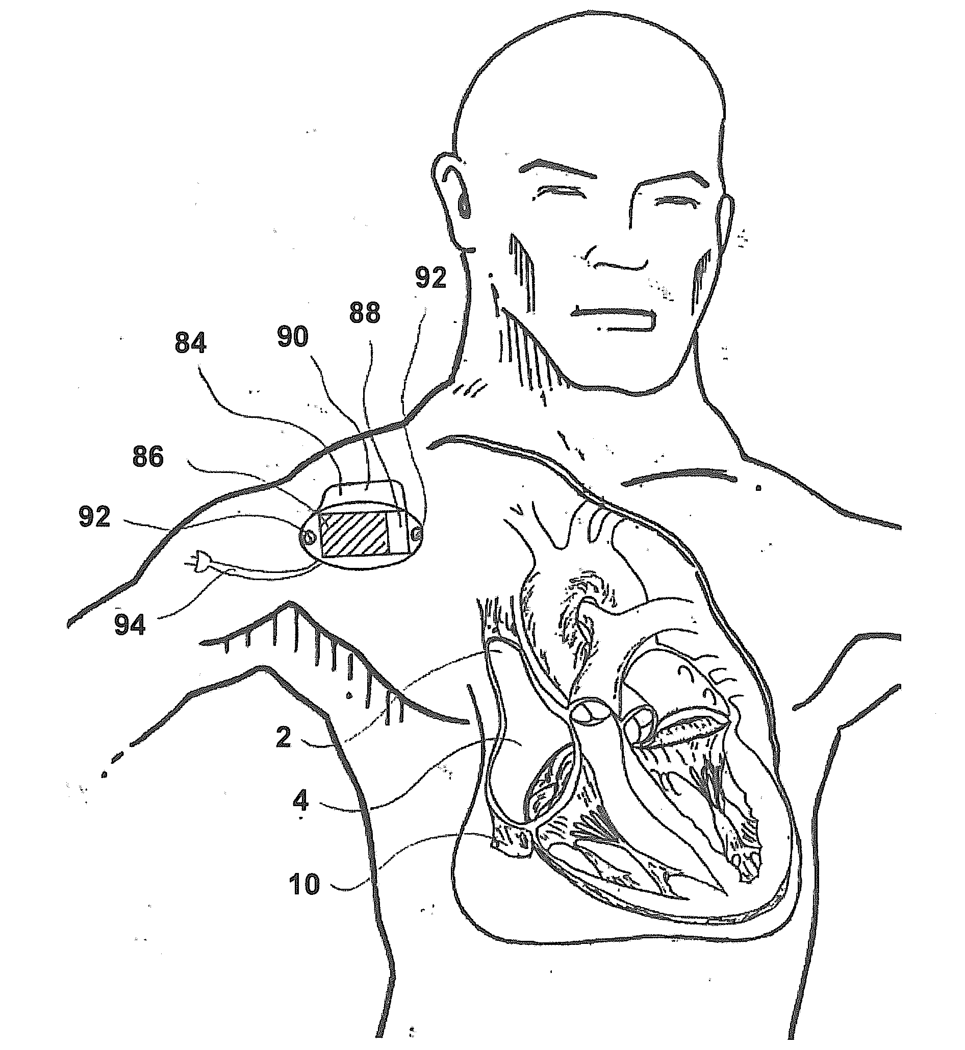 Device And A Method For Augmenting Heart Function
