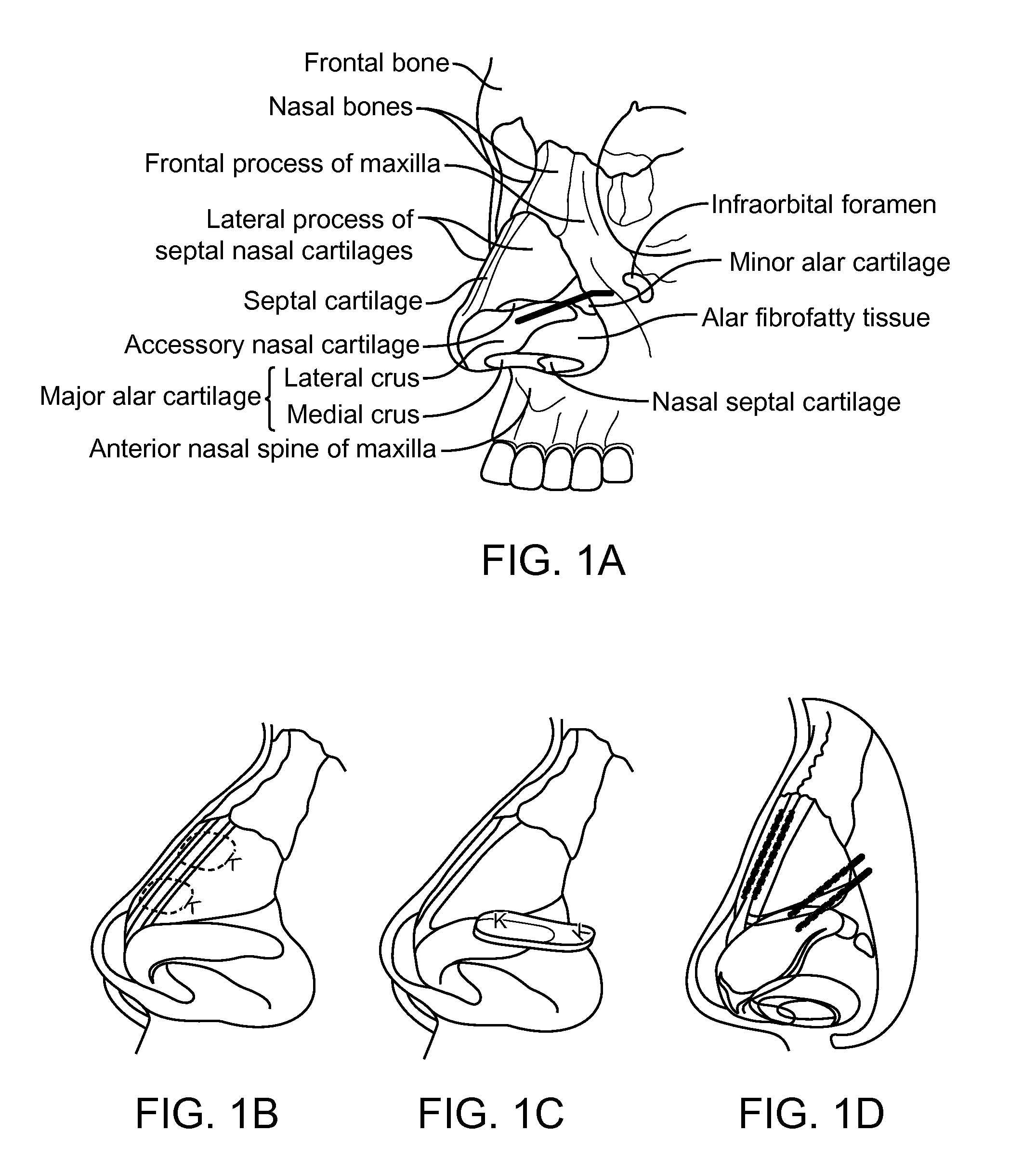Nasal implants and systems and methods of use