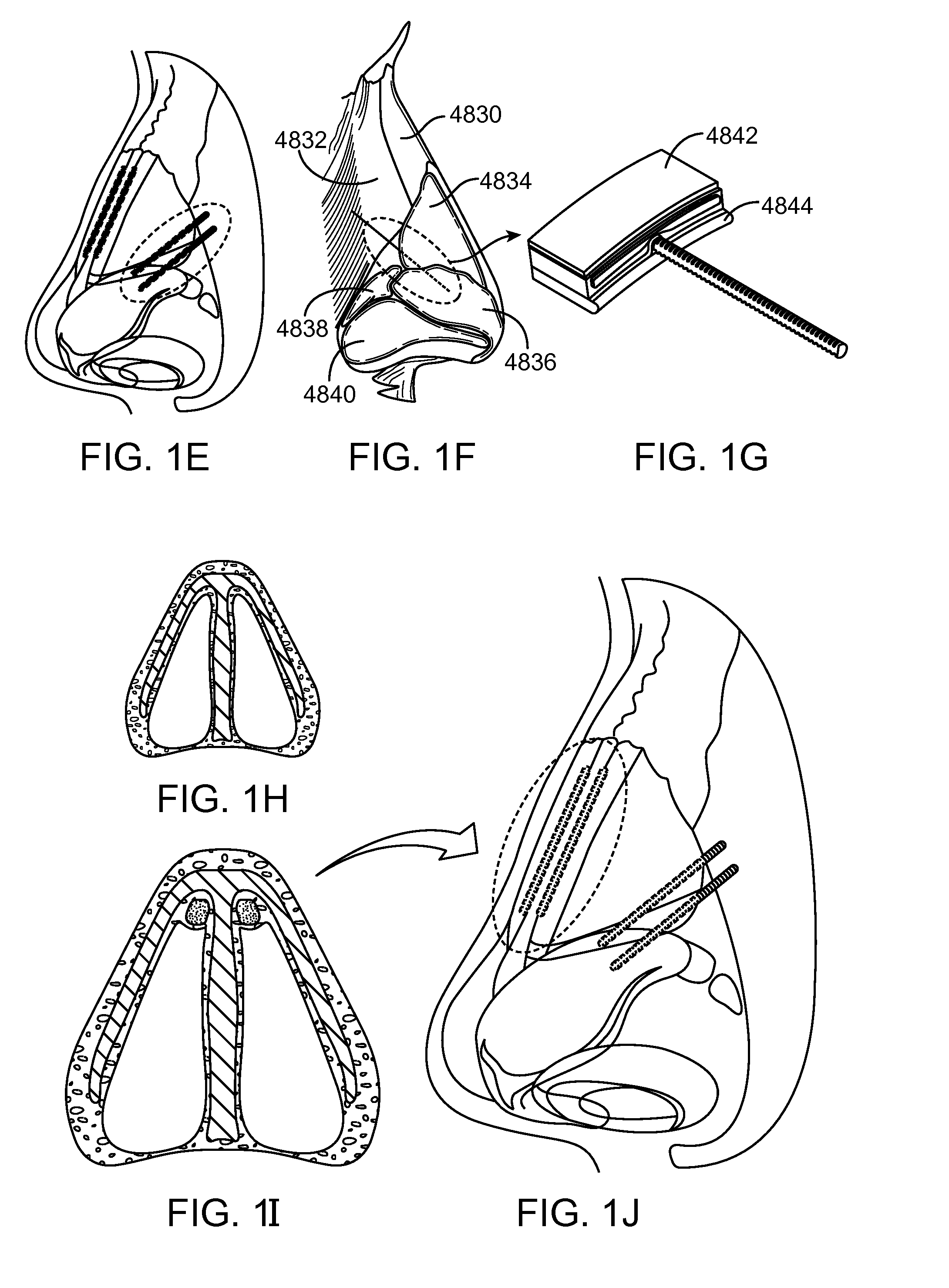 Nasal implants and systems and methods of use