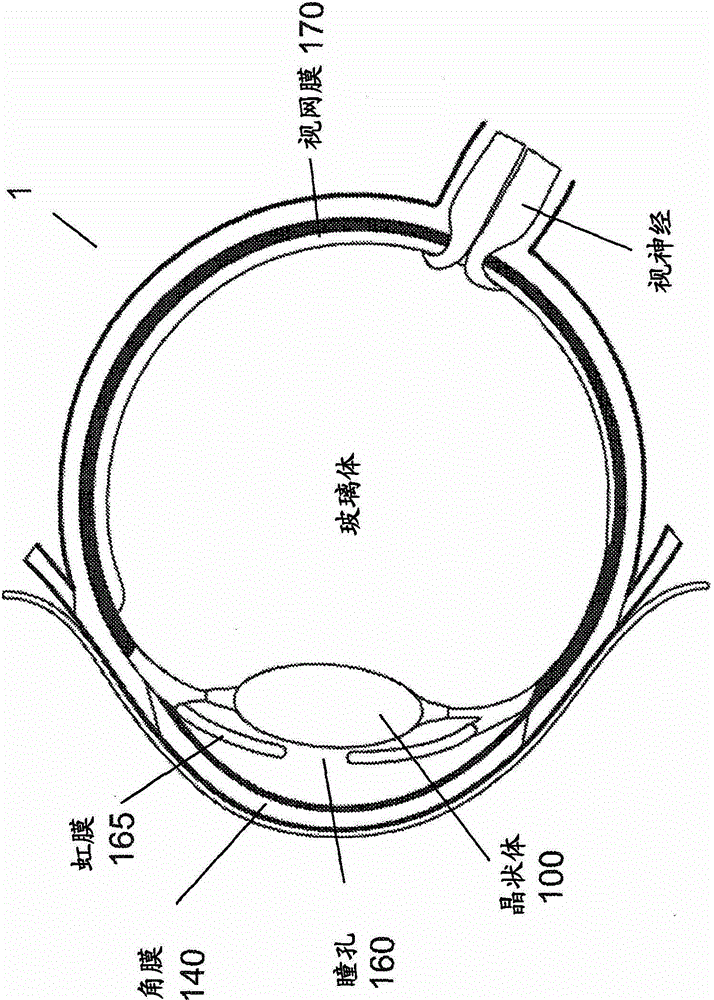 Method and device for integrating cataract surgery with glaucoma or astigmatism surgery
