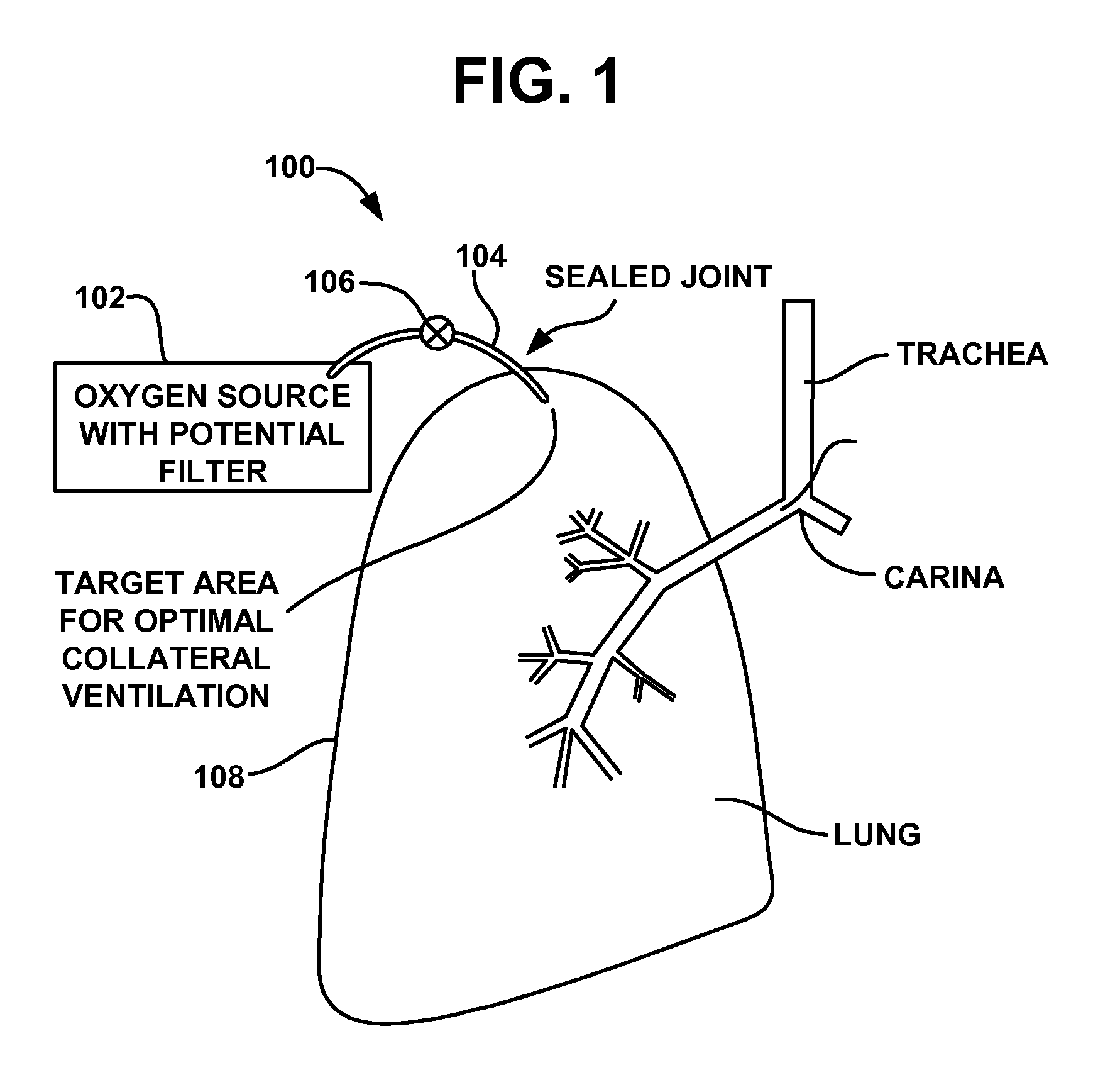 Collateral ventilation device with chest tube/evacuation features and method