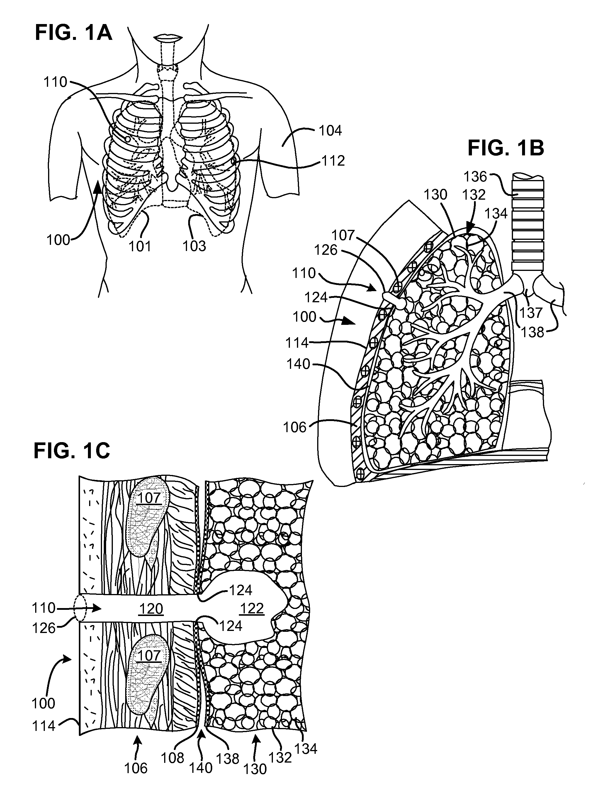 Pneumostoma management device with integrated patency sensor and method