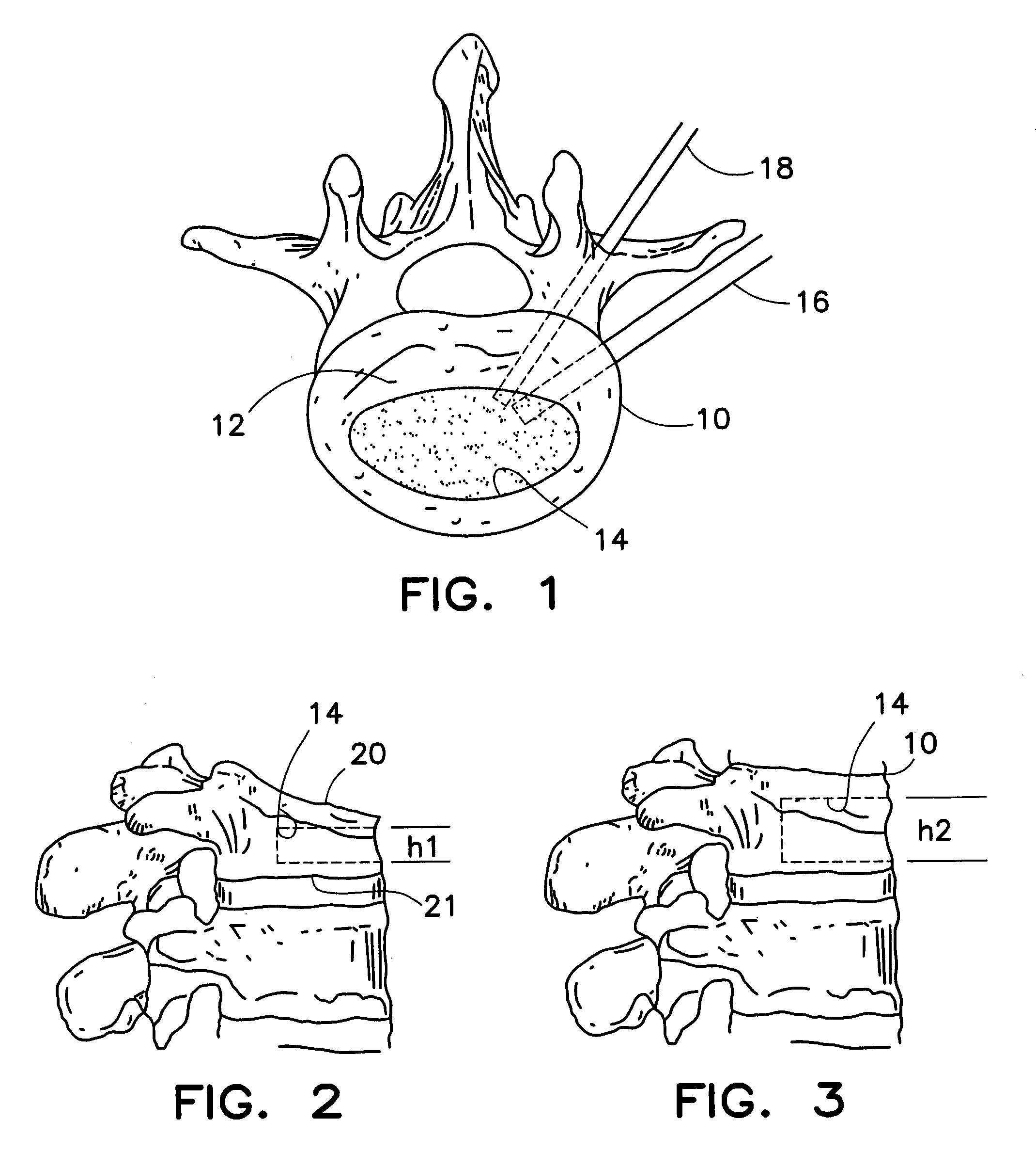 Method and apparatus for treating a vertebral body