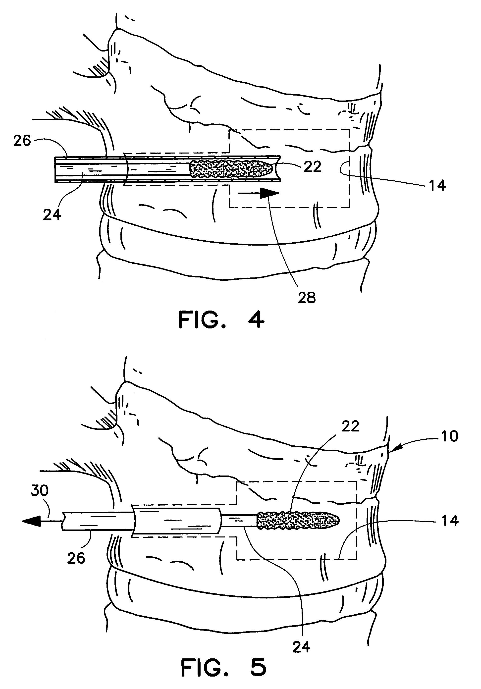 Method and apparatus for treating a vertebral body