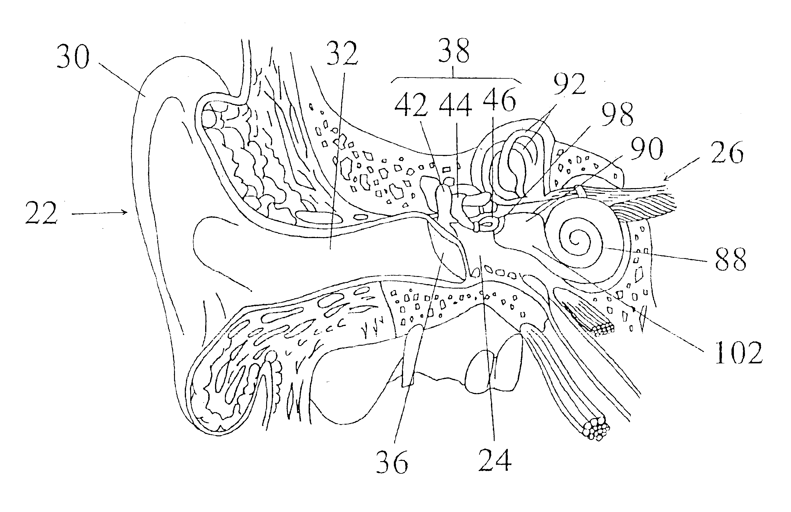 Method for creating a coupling between a device and an ear structure in an implantable hearing assistance device