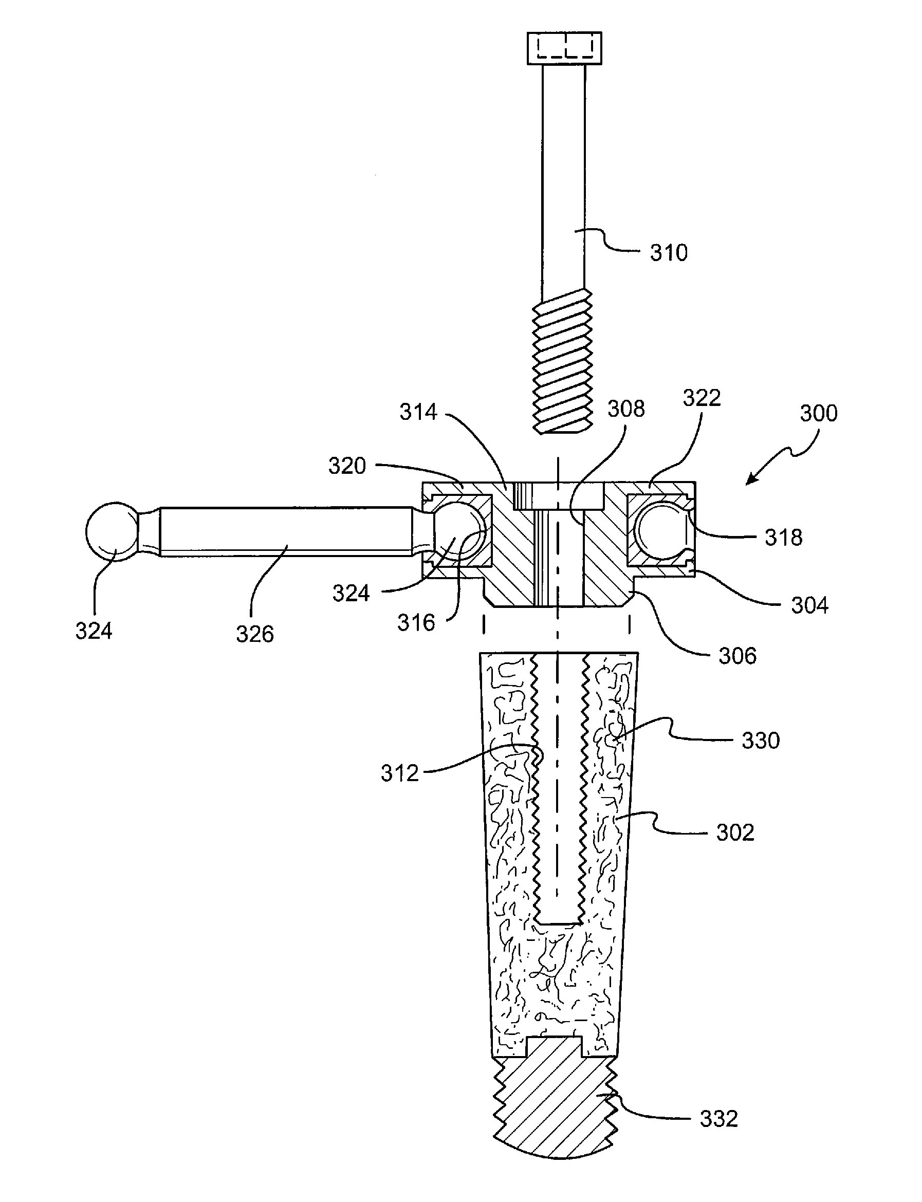 Porous Implant Device for Supporting a Denture