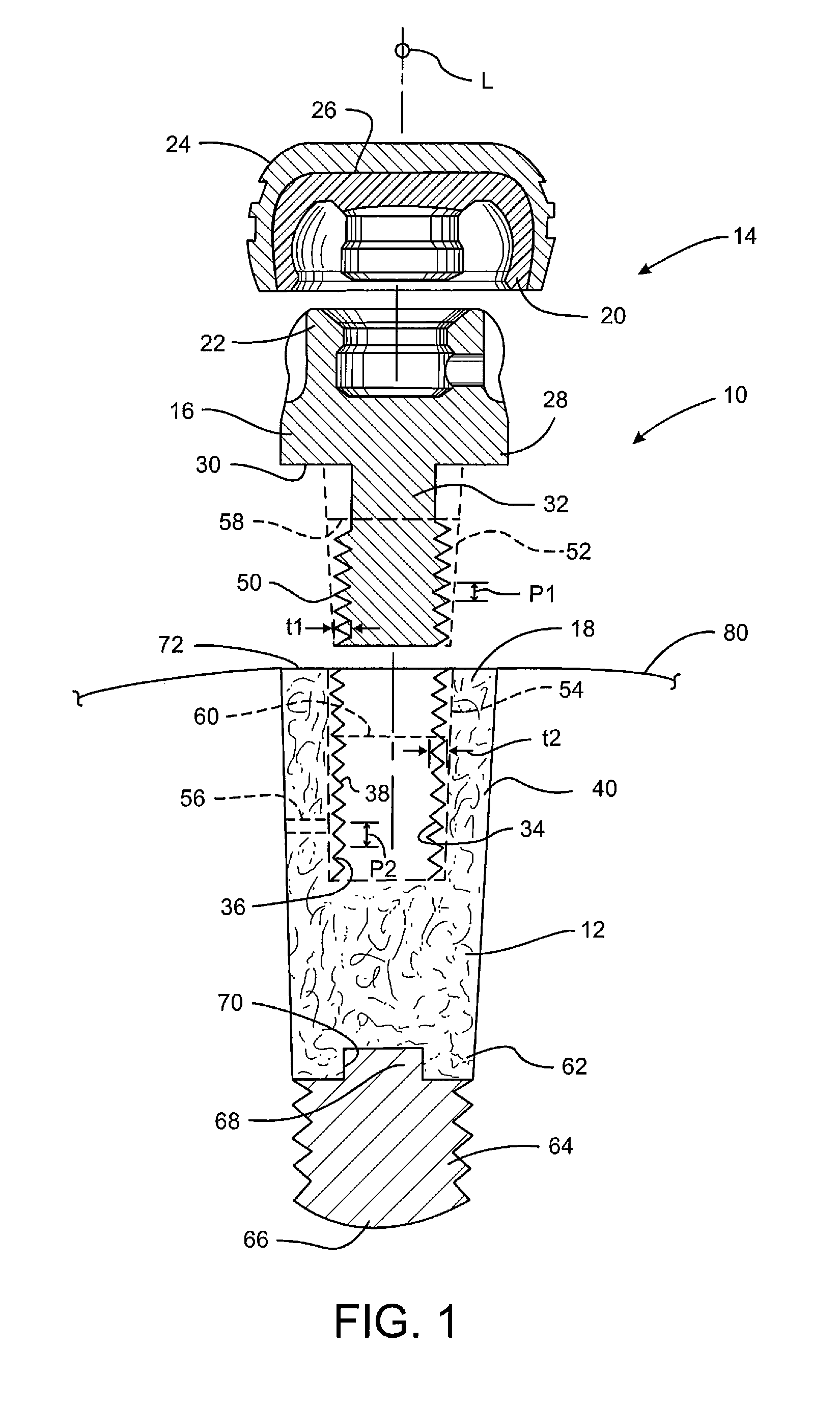 Porous Implant Device for Supporting a Denture