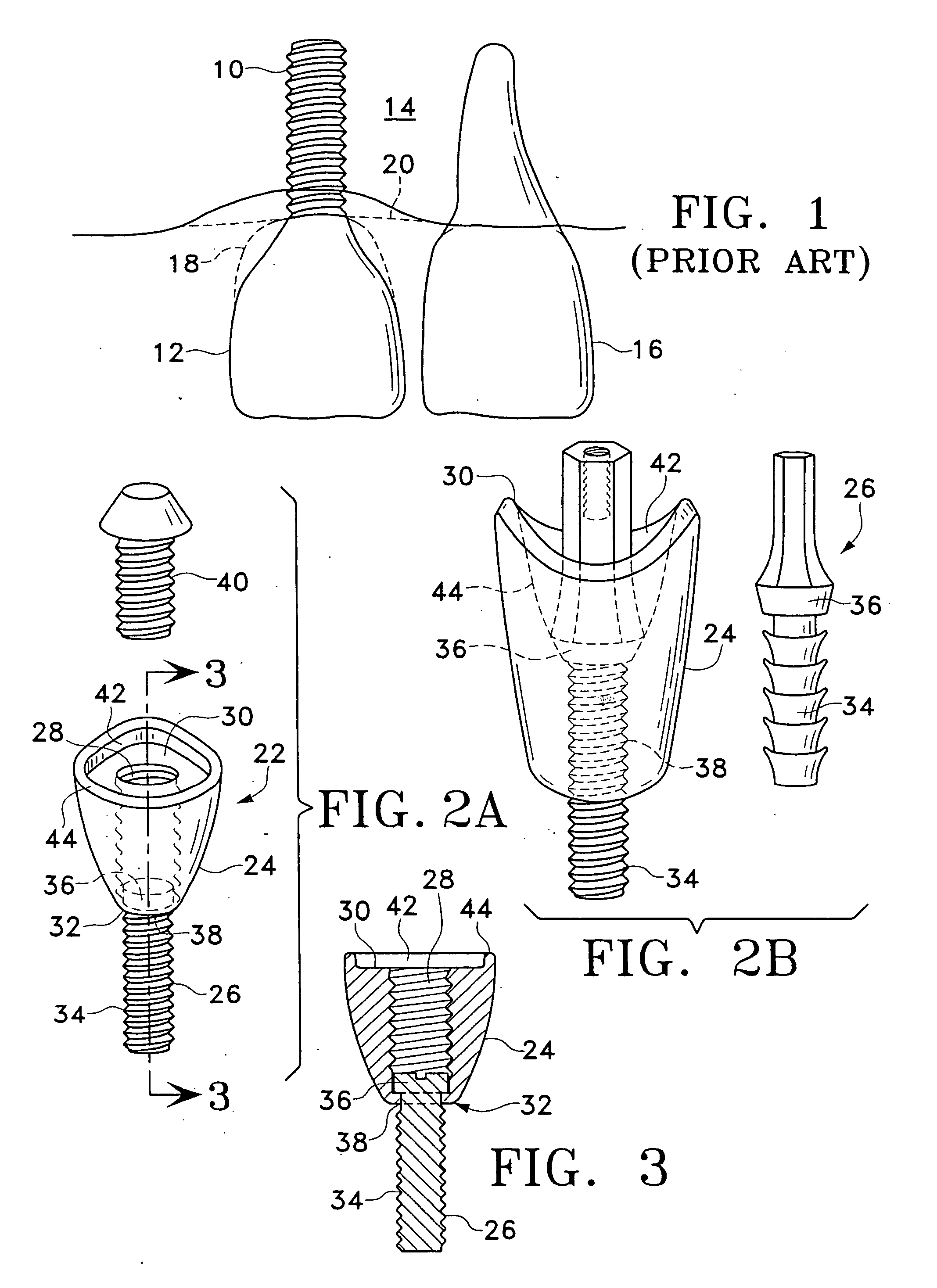 Method and apparatus for dental implants