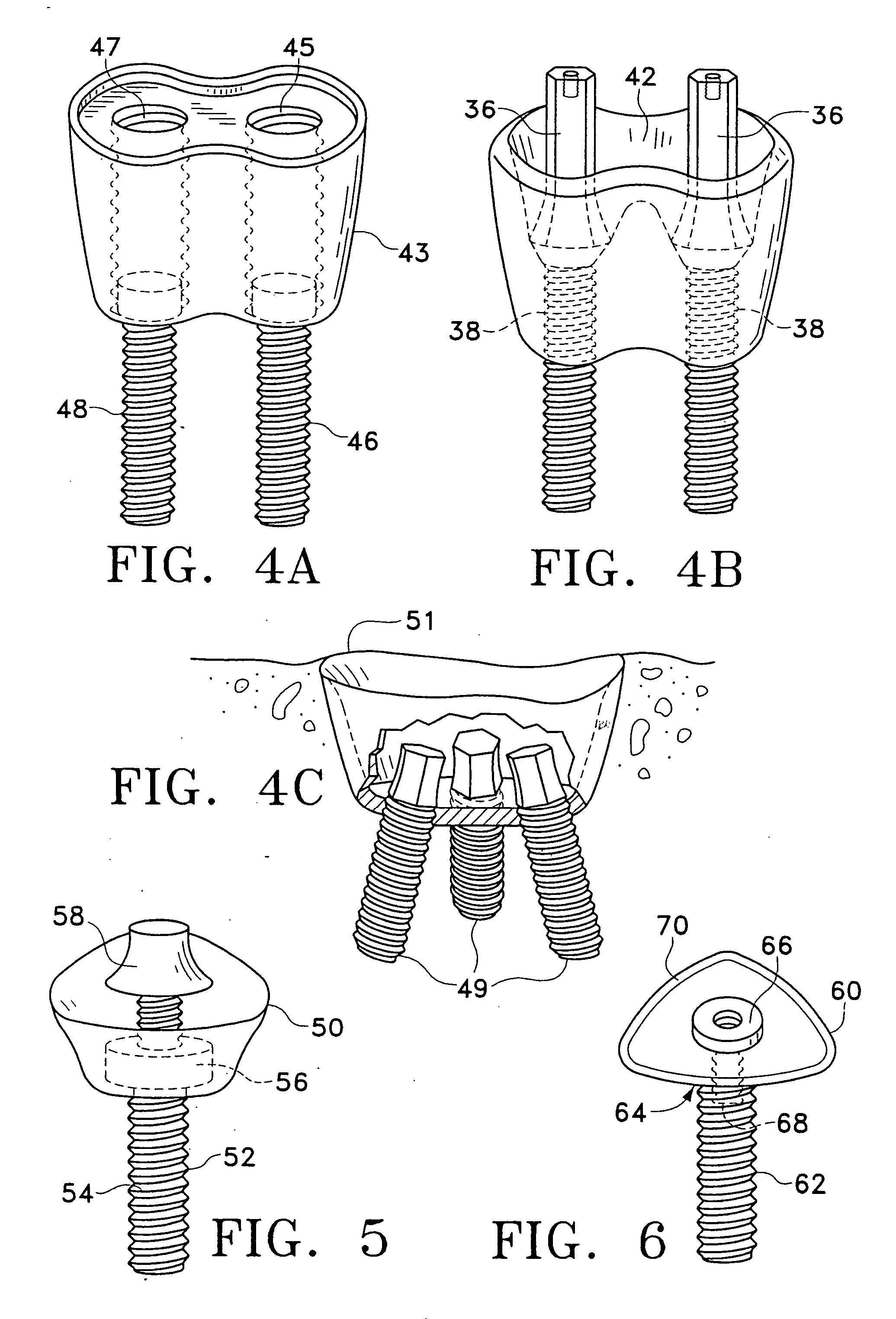 Method and apparatus for dental implants