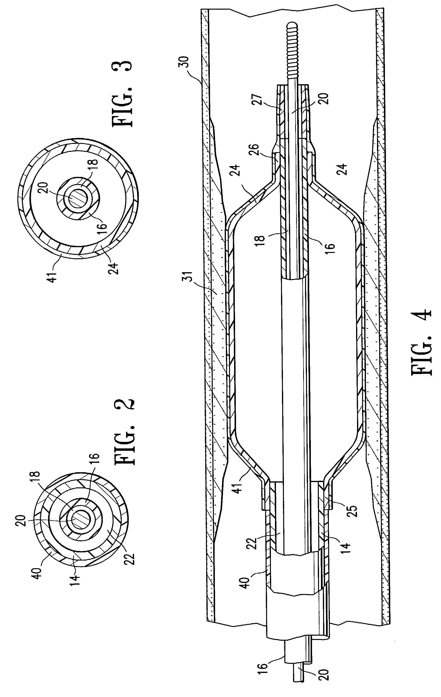 Reduced slippage balloon catheter and method of using same
