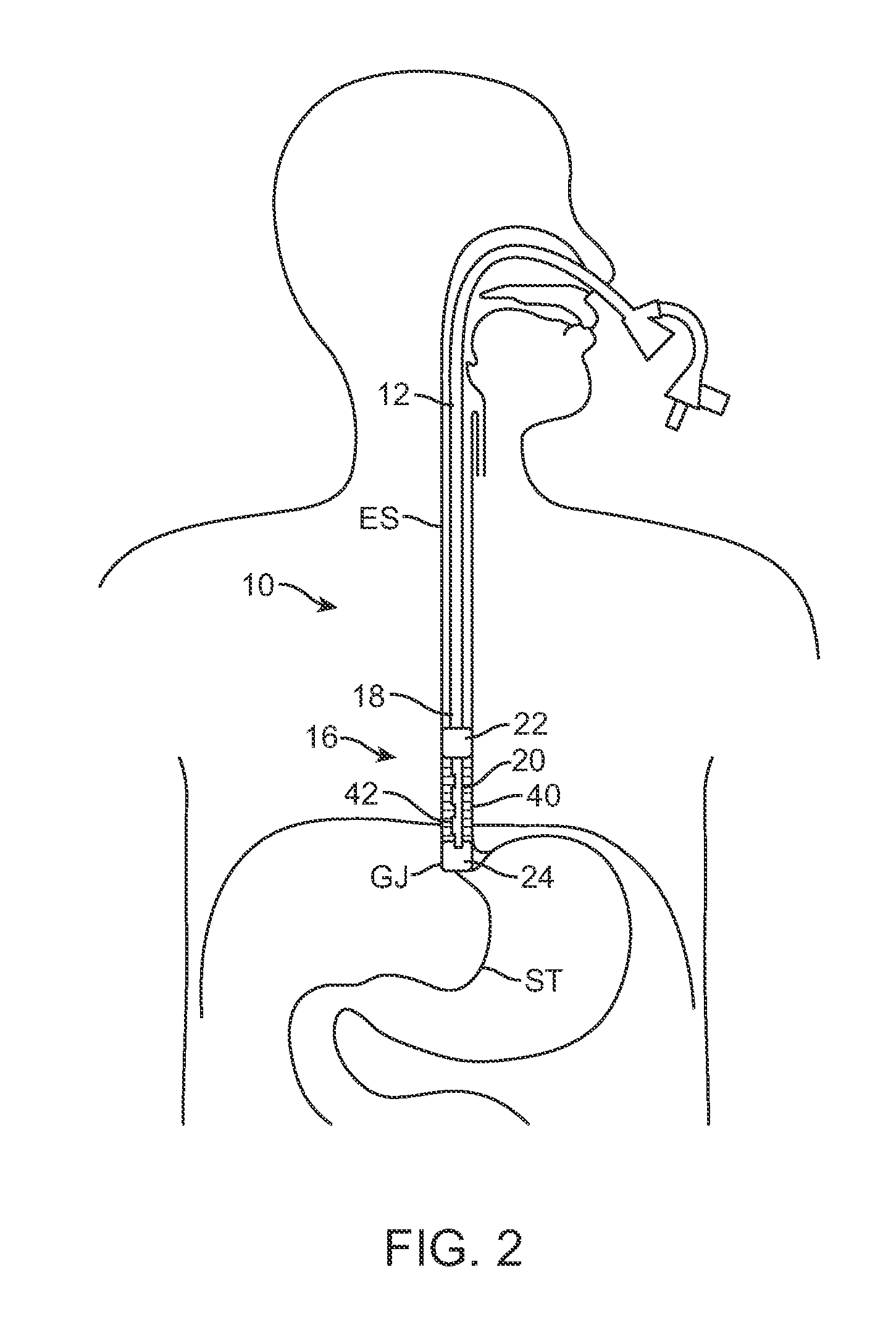 Methods and apparatus for cyrogenic treatment of a body cavity or lumen