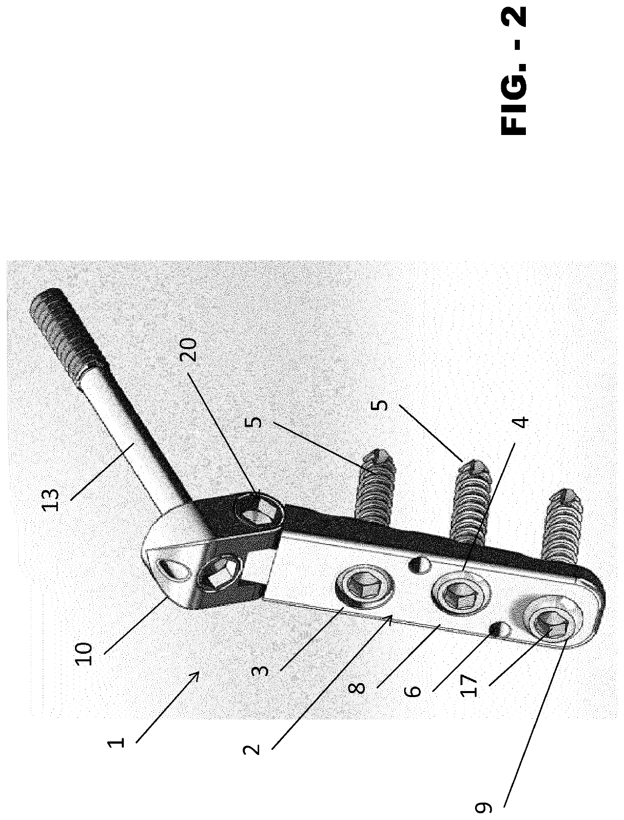 Internal fixation device for the pediatric correction of severe bone malformations