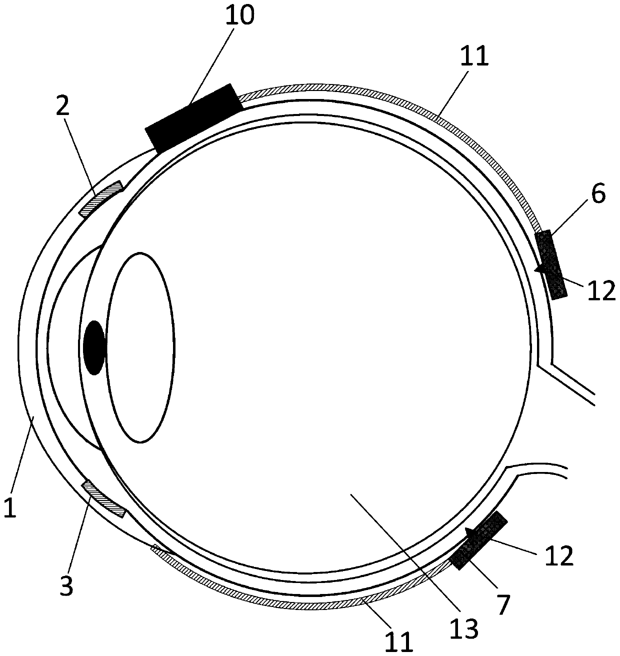 Extraocular electrode array equipment for local electric stimulation of retina