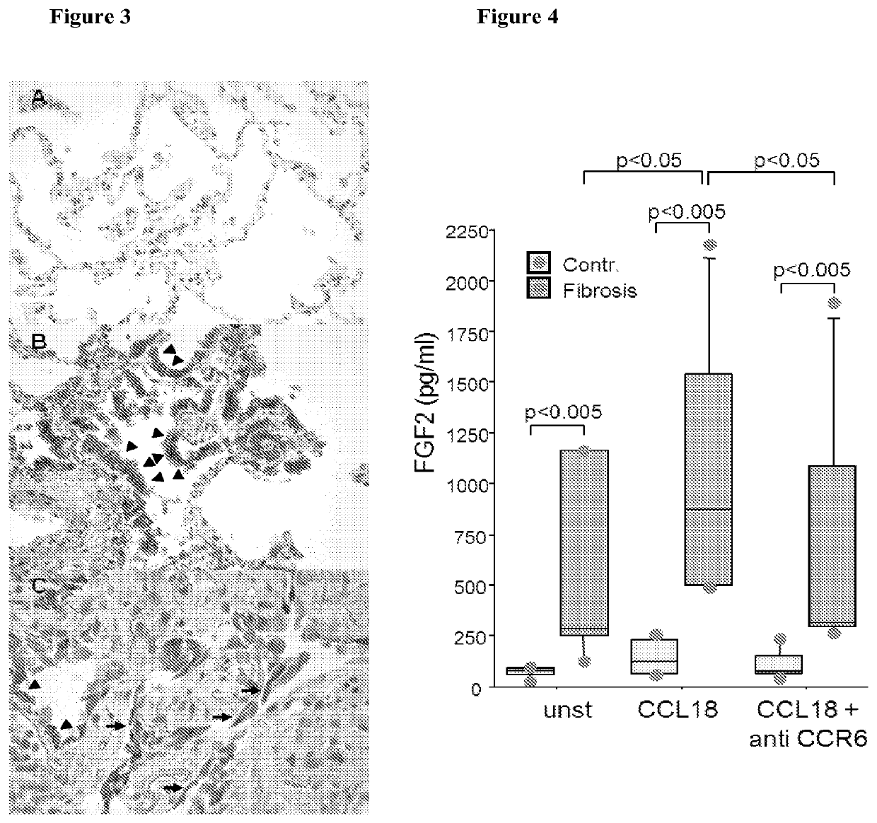 Blockade of CCL18 signaling via CCR6 as a therapeutic option in treating interstitial lung disease