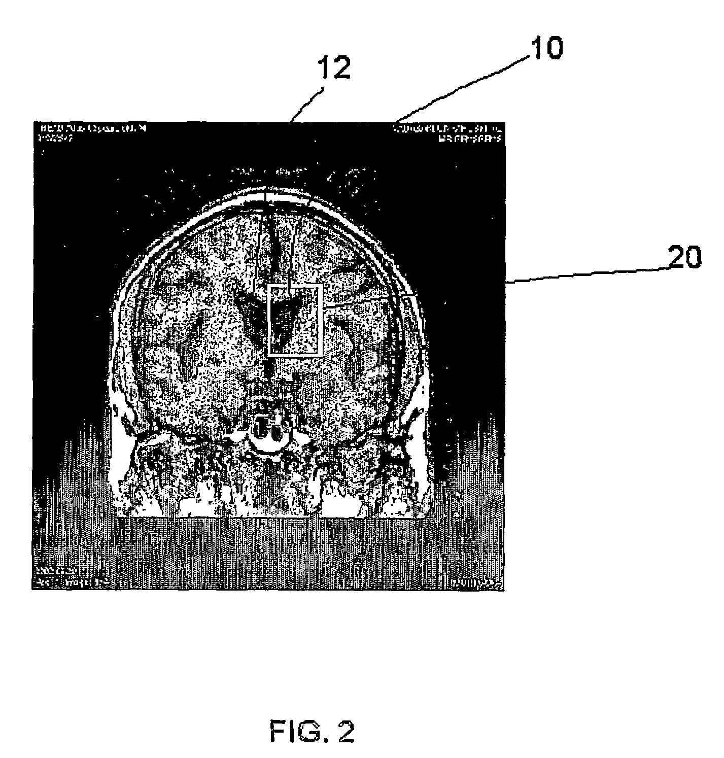 Method and apparatus for extracting cerebral ventricular system from images