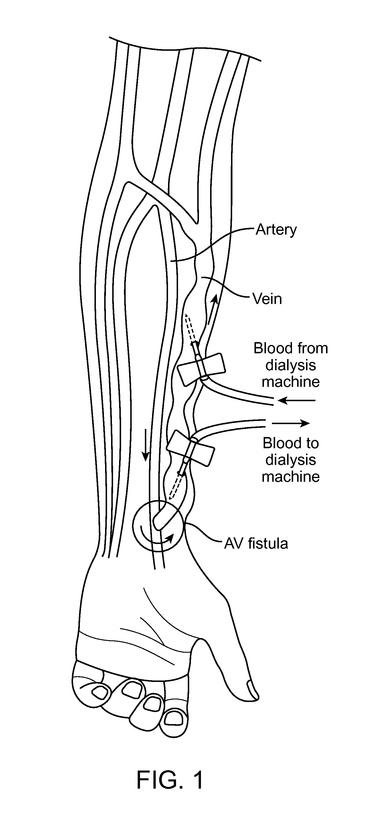 Extravascular devices supporting an arteriovenous fistula