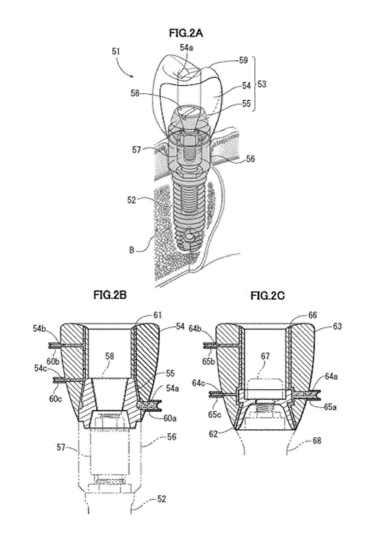 Implant superstructure