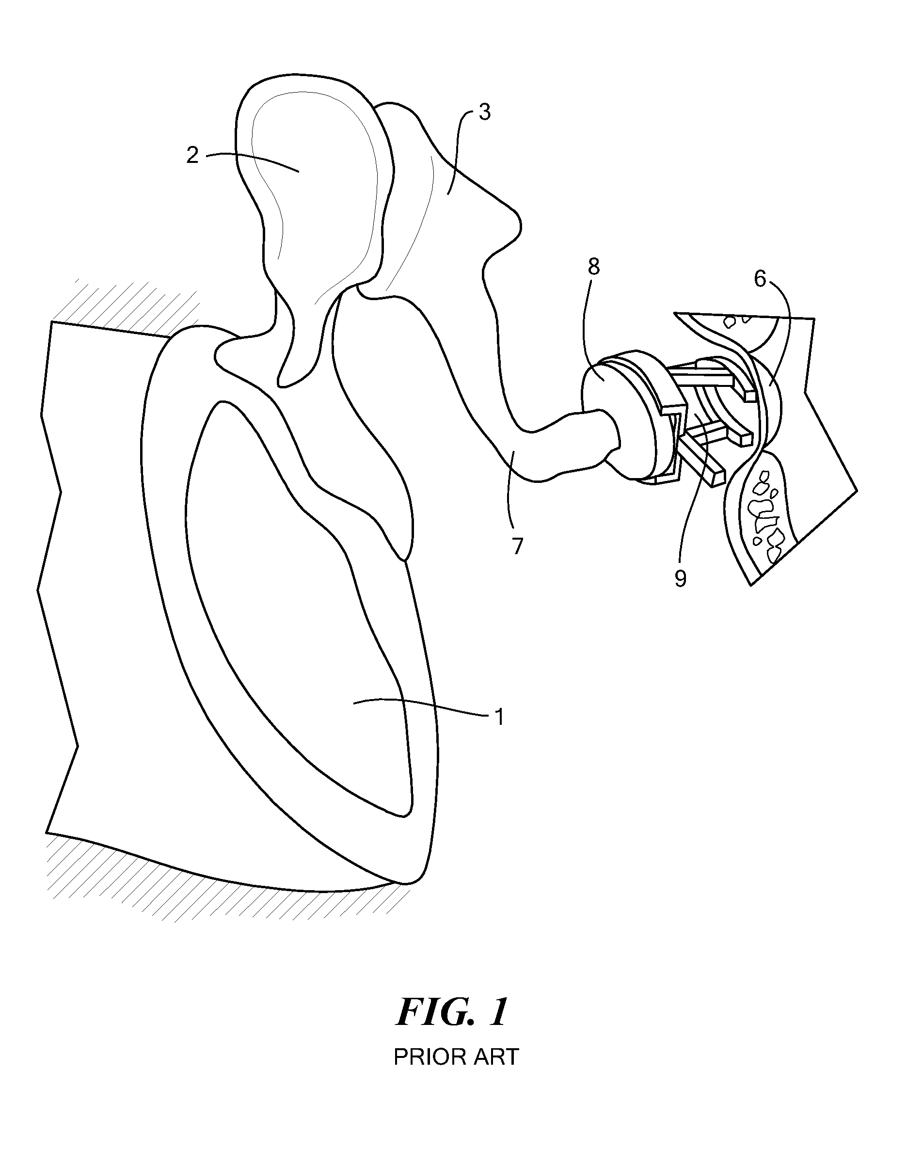 Implantable microphone for hearing systems
