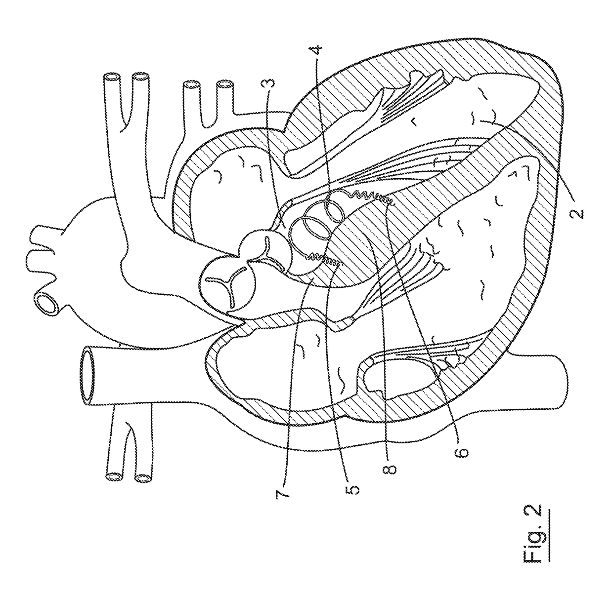 Implantable intracardiac device and methods thereof