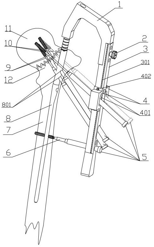 Femoral neck fracture angle stable type intramedullary fixing device