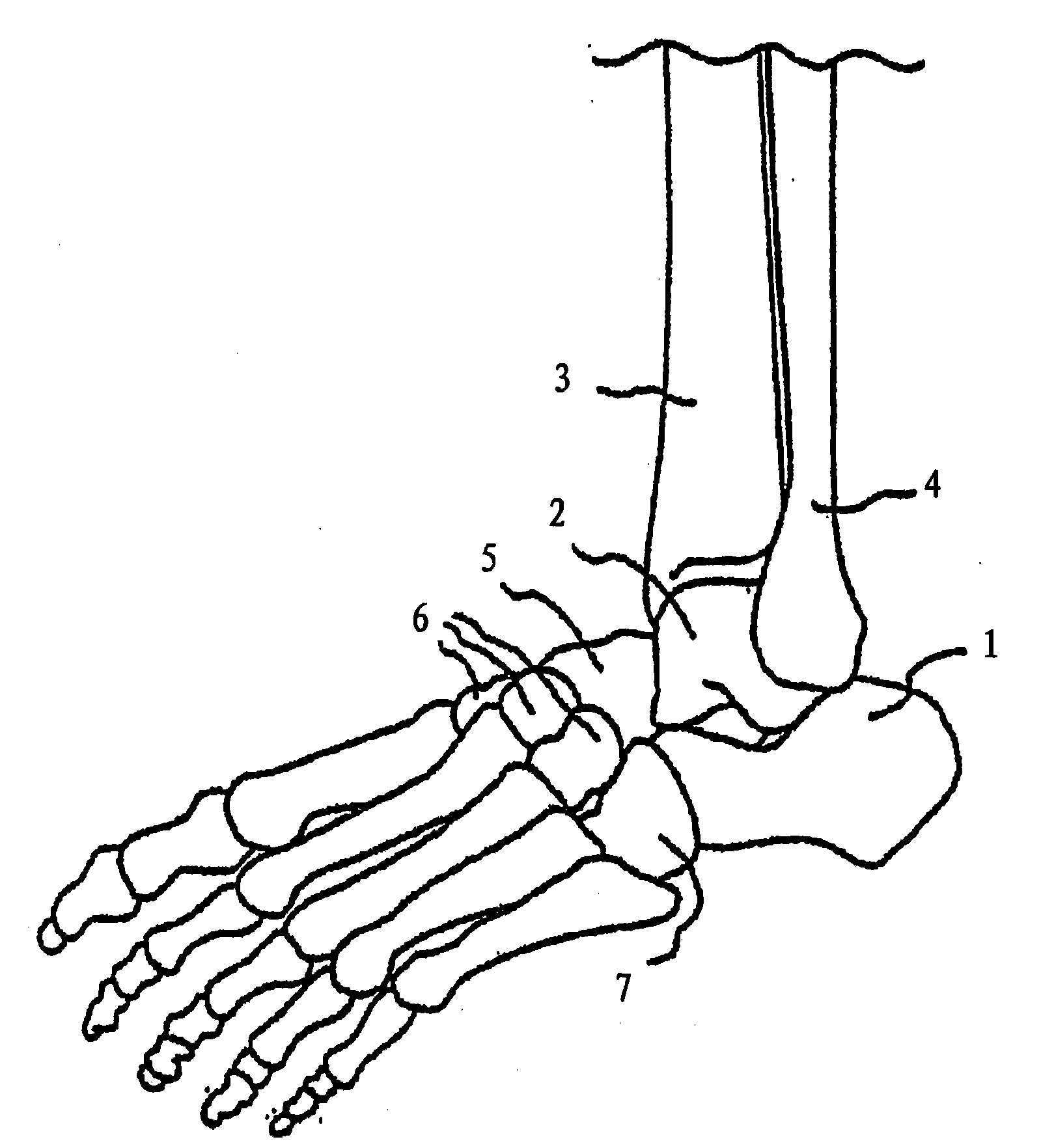 Bone nail for the heel and osteosynthesis suite
